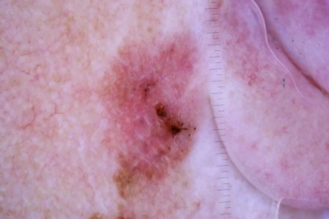 How often should I have a skin check?