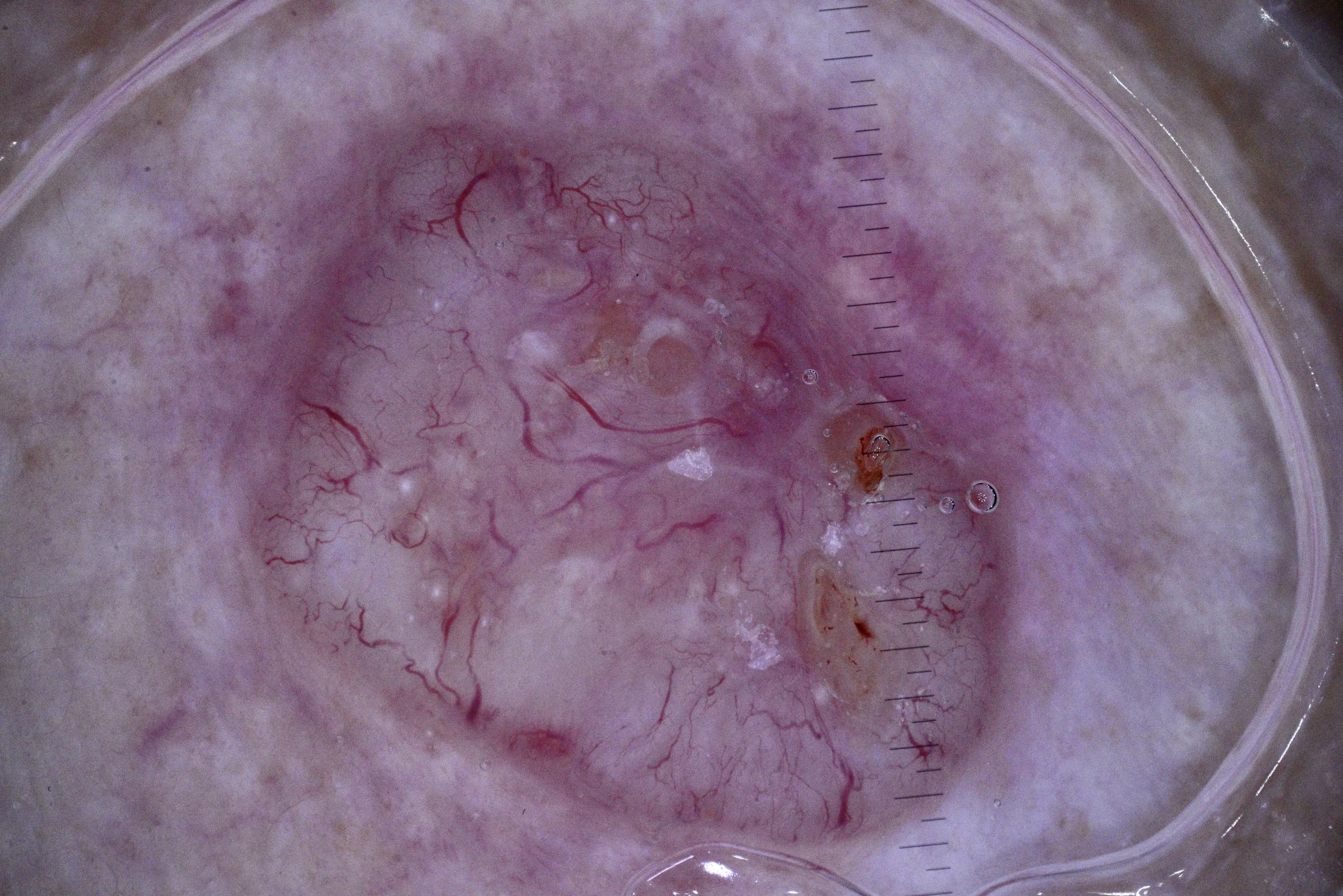 The most common but least talked about Cancer