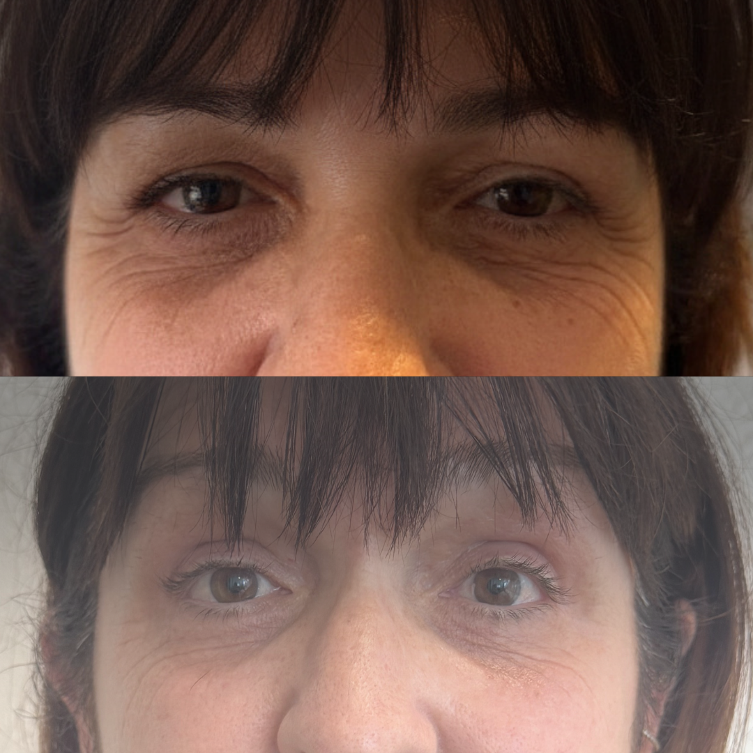 Eye Lift Sunshine Coast