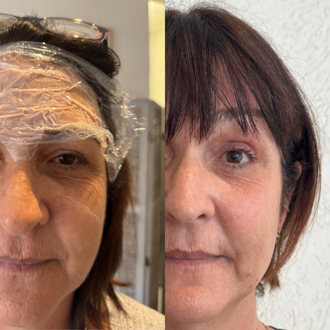 TBS plasma  (19).png