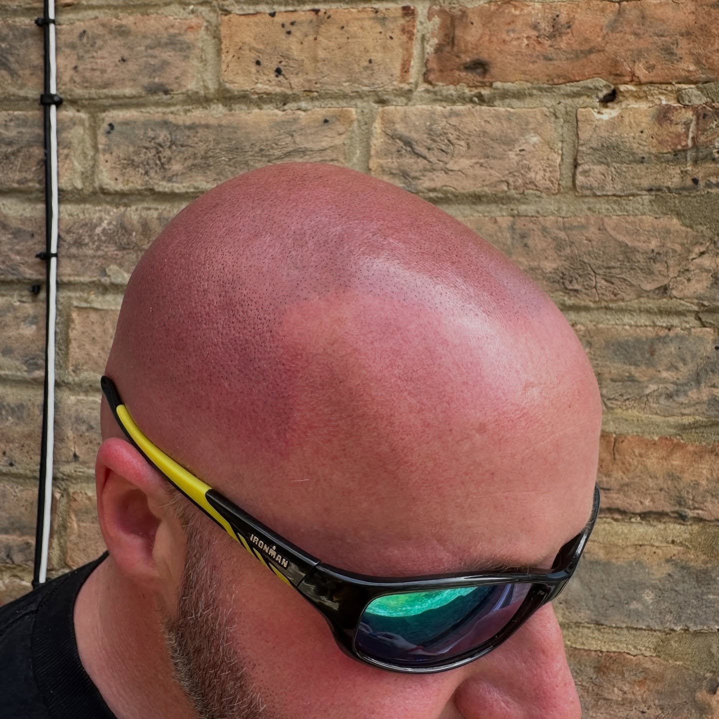 Scalp pigmentation from a while ago!
Swipe for pictures from before the treatment &gt;&gt;&gt;

Having a little hairline shadow actually takes years off of people!!! It frames the face and stops you looking like a giant thumb!

We can do a full top o