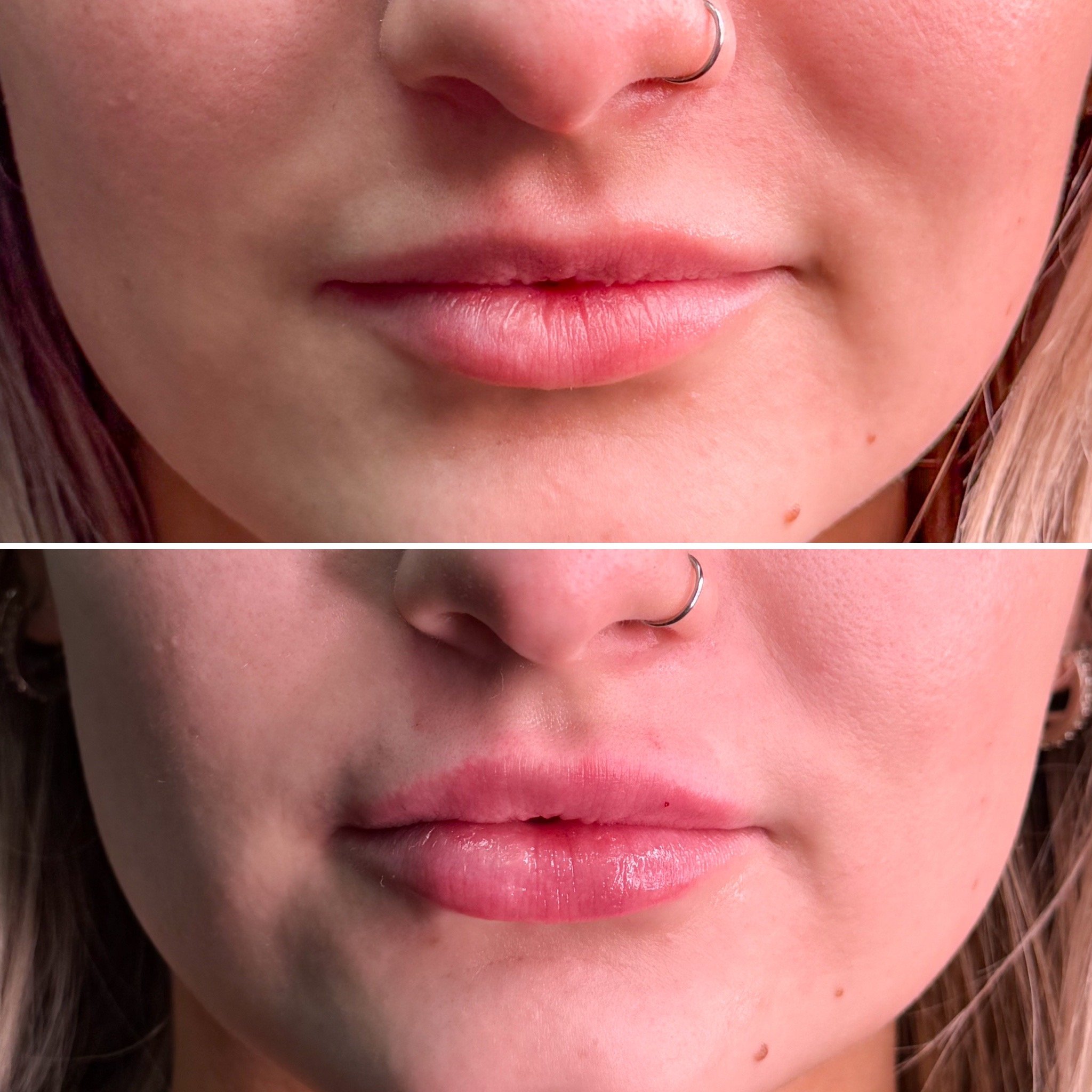 Natural lip filler results at The Injection Room NoCo.JPG