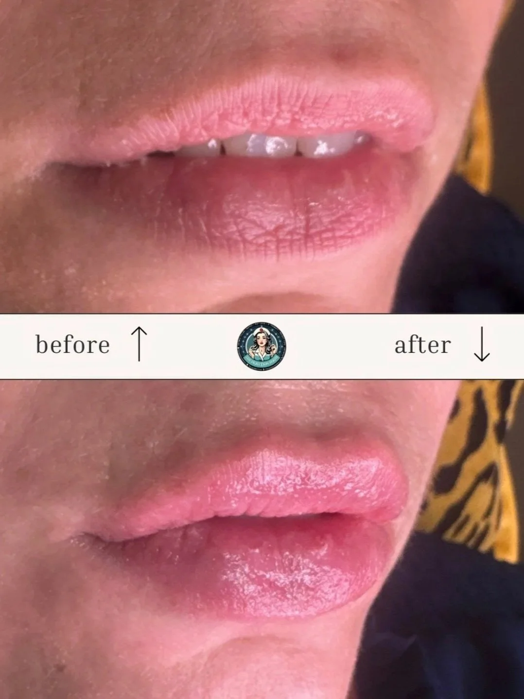 Lip Filler  | The Injection Room NoCo.jpg