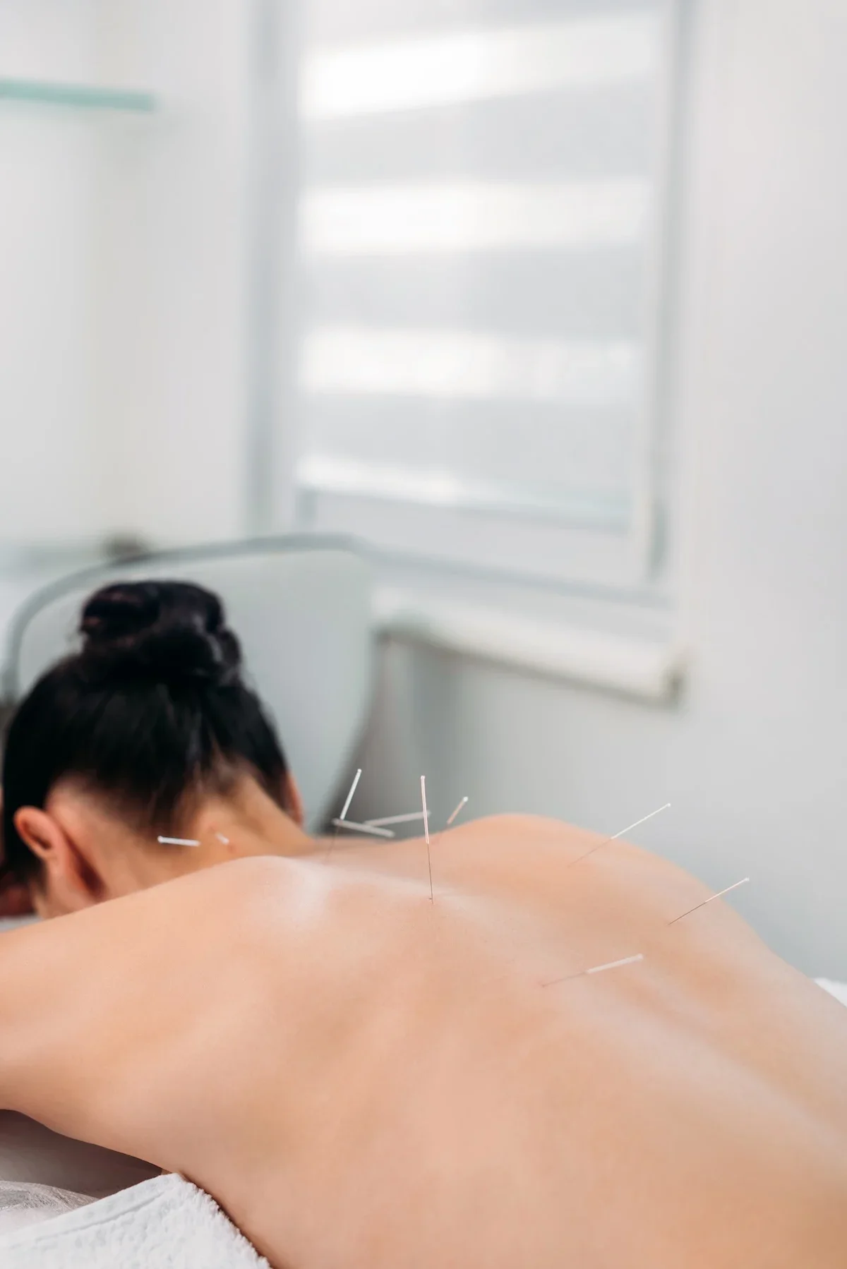 A midlife woman lies face down on a table with several acupuncture needles inserted into her bare back in a clinical setting.