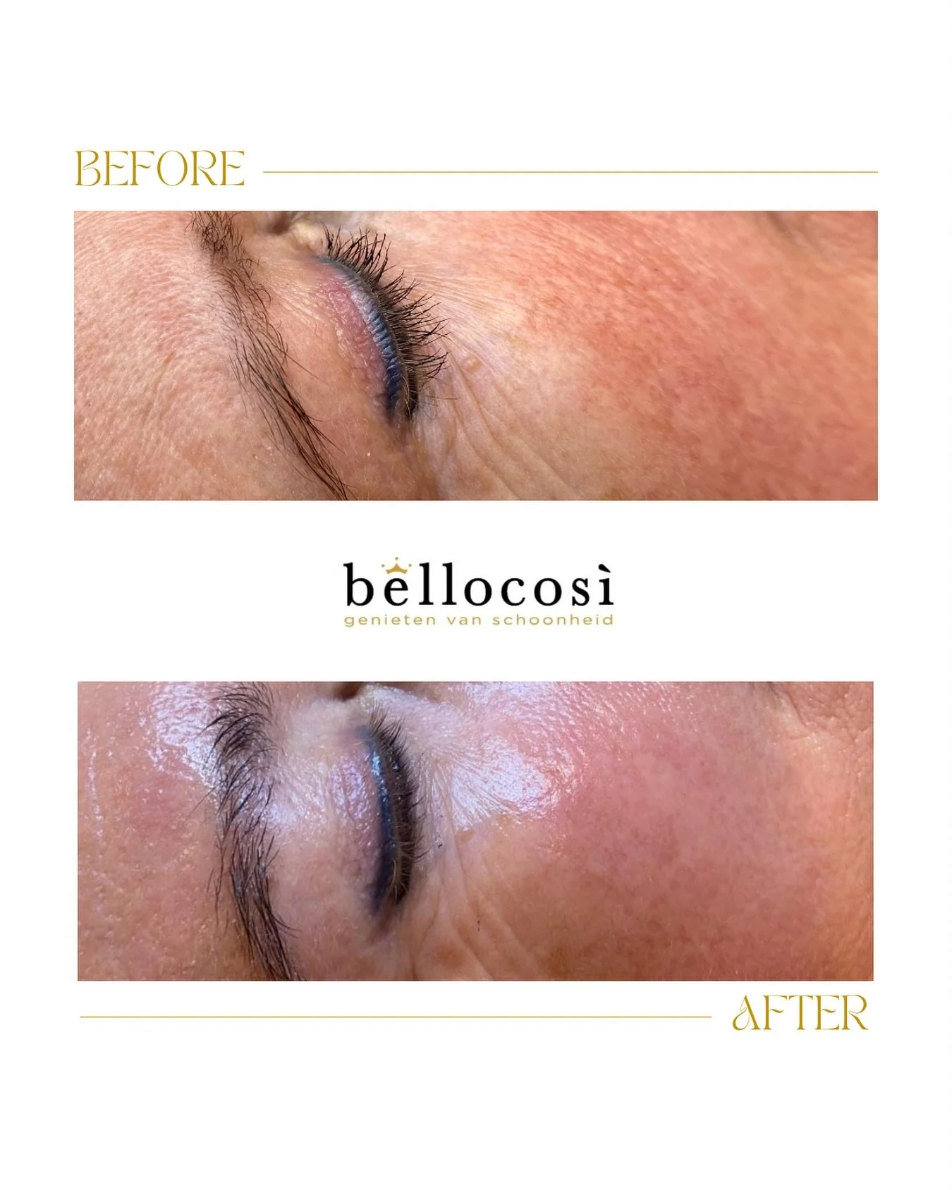 ✨ Resultaat na slechts 1 zurenpeel behandeling + afwerking met Icontime producten! ✨

De huid oogt direct gezonder, frisser en voller met een verfijnde structuur, minder zichtbare pori&euml;n, mooie glow, &eacute;n minder dof. 

Een mooie boost voor 