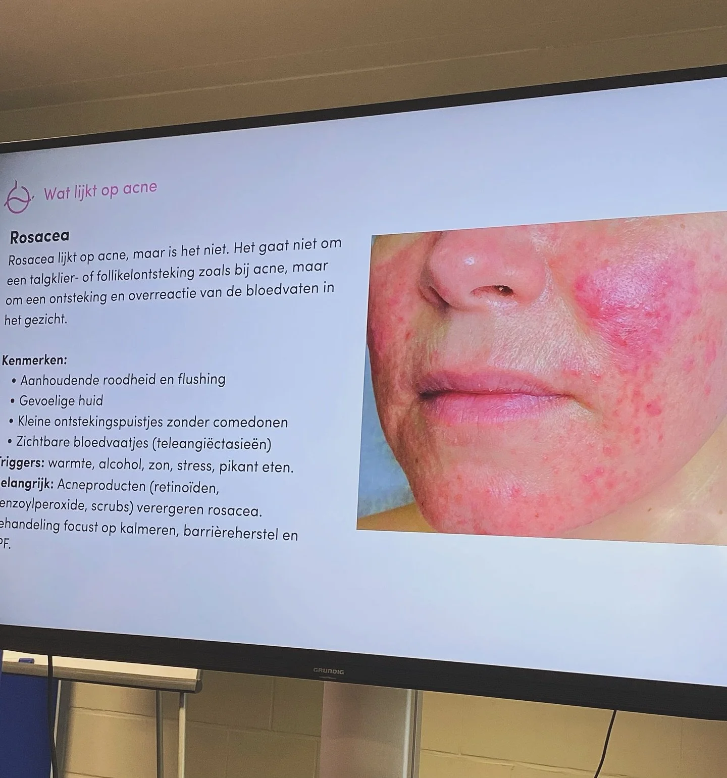 Gisteren heb ik een gespecialiseerde opleiding rond acn&eacute; gevolgd 🤍

We gingen dieper in op het ontstaan van acn&eacute;, de verschillende vormen, de invloed van erfelijkheid. hormonen en huidflora en de medische behandelmogelijkheden. Daarnaa