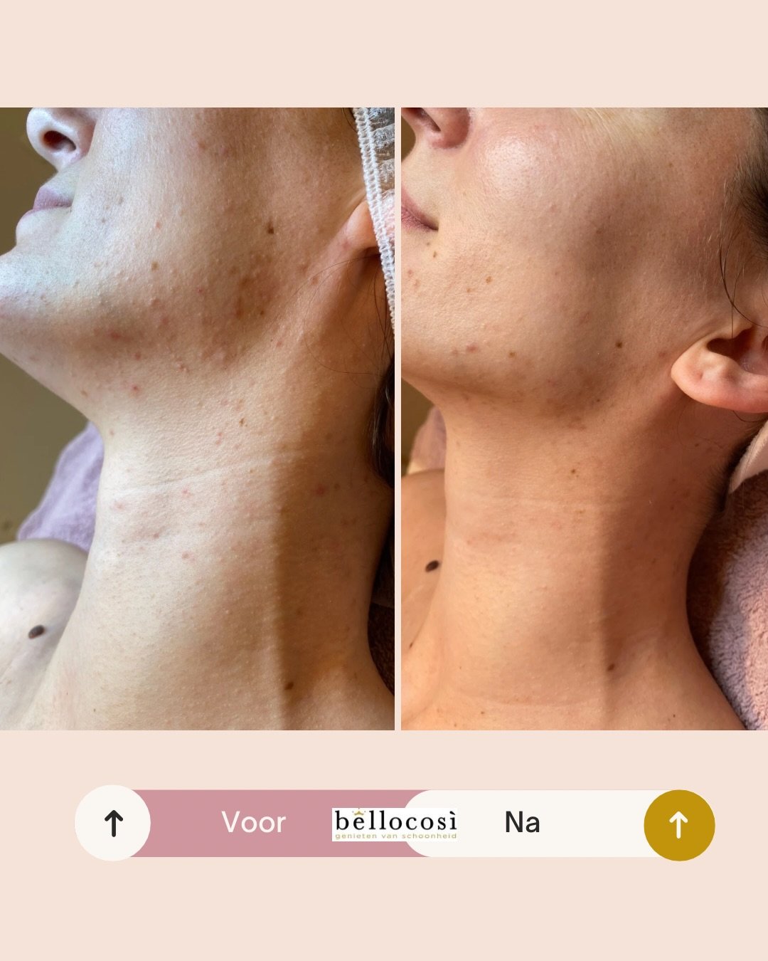 Een huid klaar voor haar mooiste dag. 💍❤️

Deze bruid kwam bij mij met een doffe huid, volwassen acn&eacute;, vochttekort, roodheid en gevoeligheid. Na een zurenkuur van 6 behandelingen en het consequent opvolgen van de thuisadviezen is dit het resu