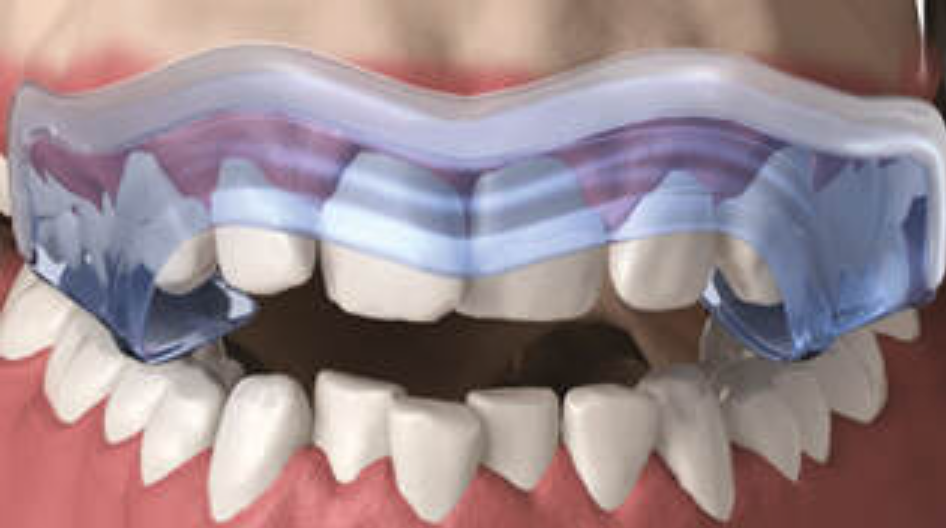 Aqualizer self-adjusting oral splint fit 2.png