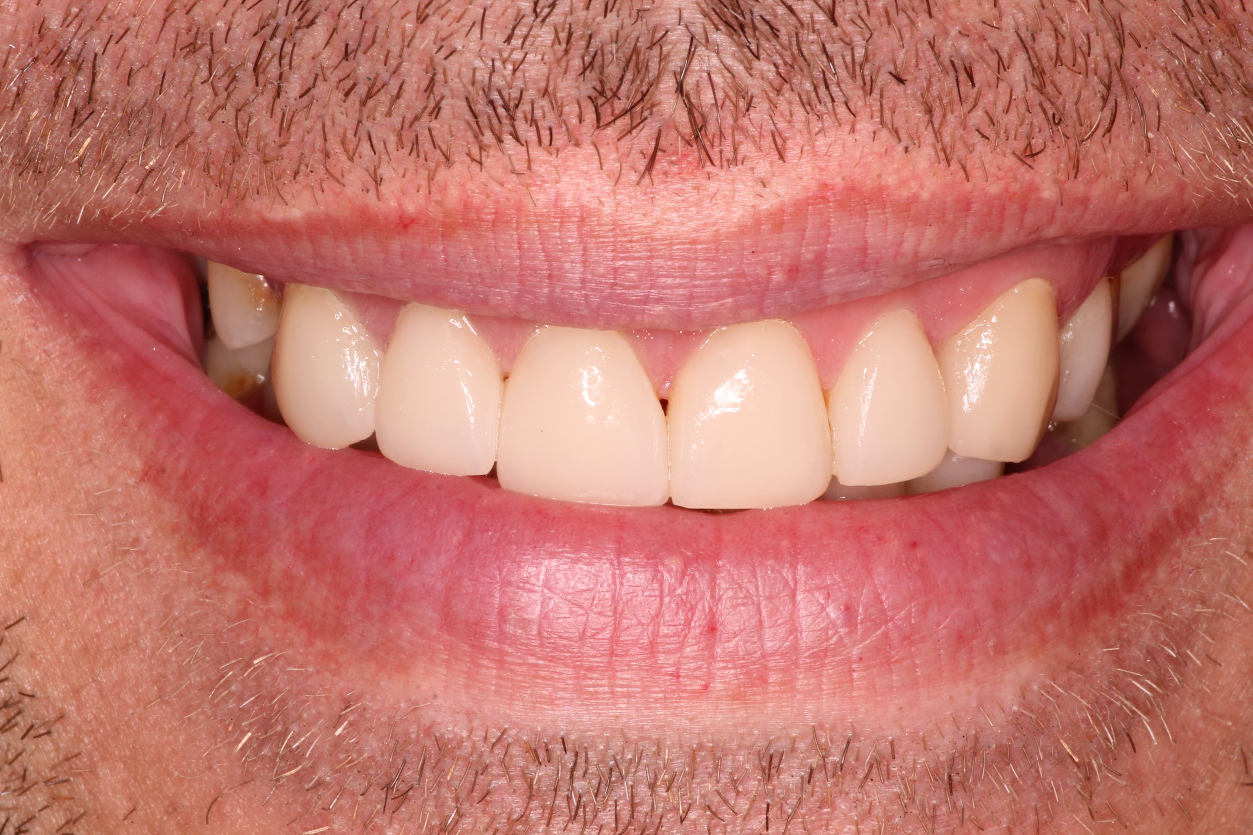 Close-up of a person's smiling mouth showing upper and lower teeth with some visible dental imperfections.