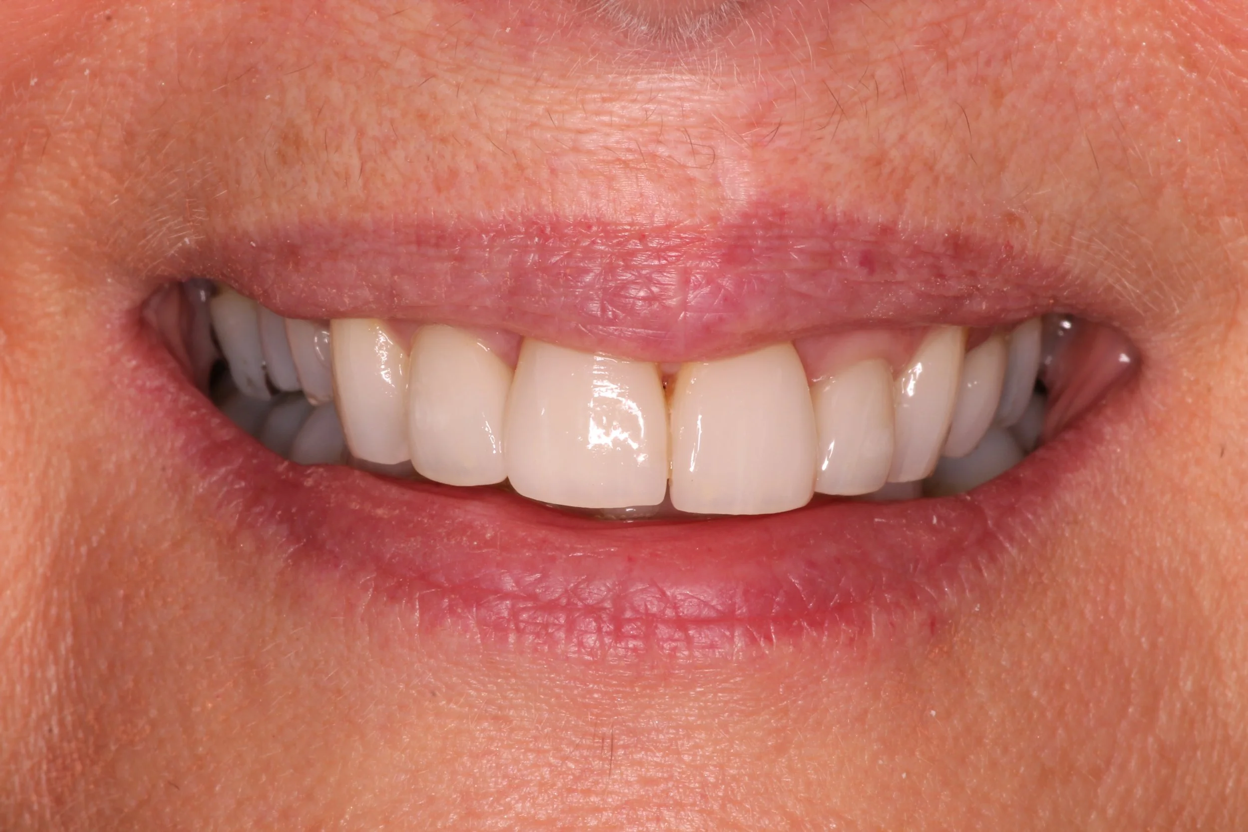 Close-up of a person's smiling mouth showing their teeth and lips.