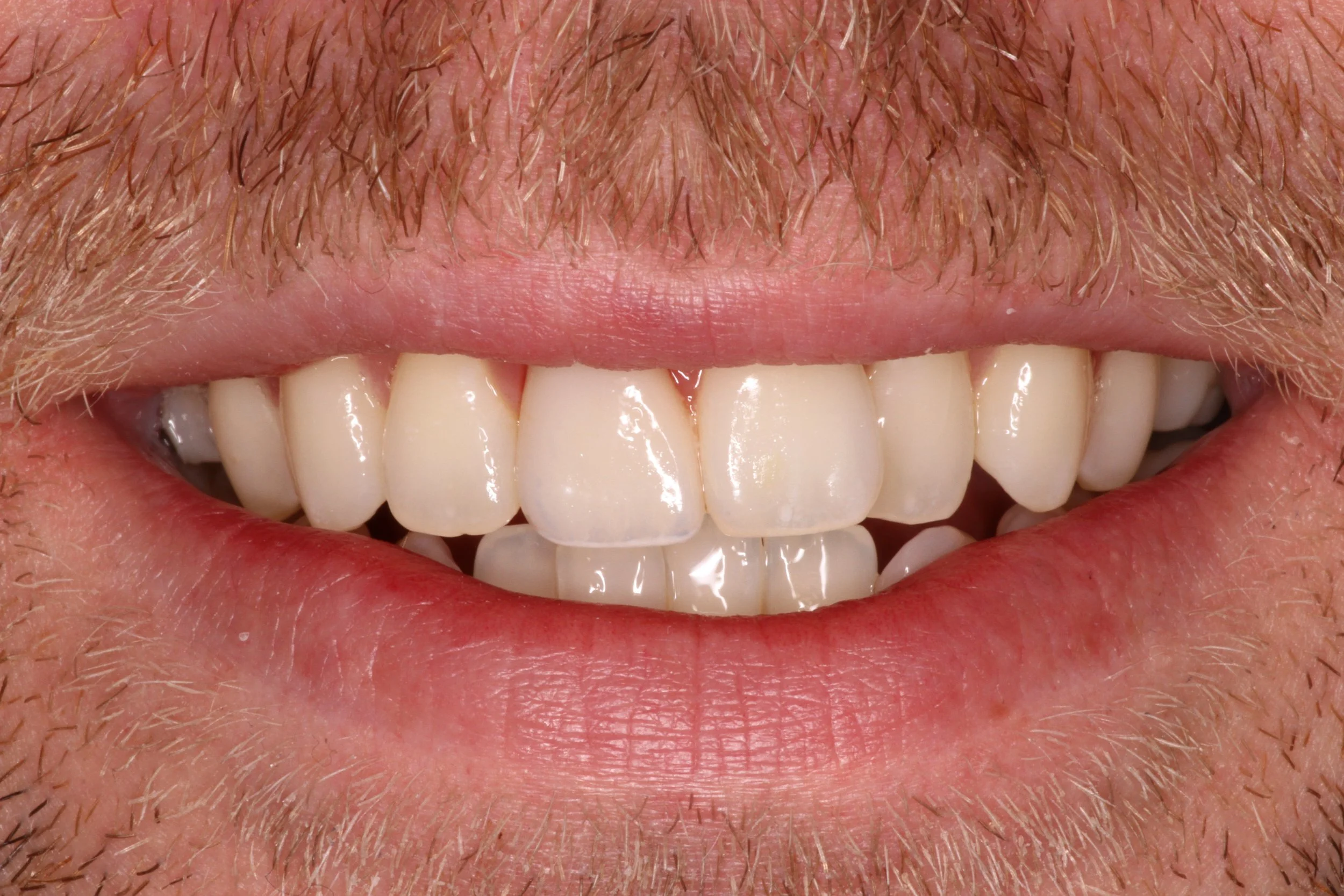 Close-up of a person's smile showing their teeth and lips.