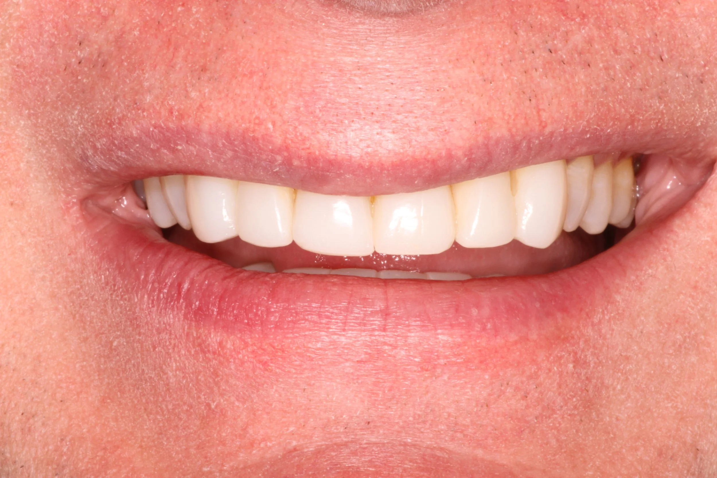 A close-up of a person's smile showing white, straight teeth and pink lips.