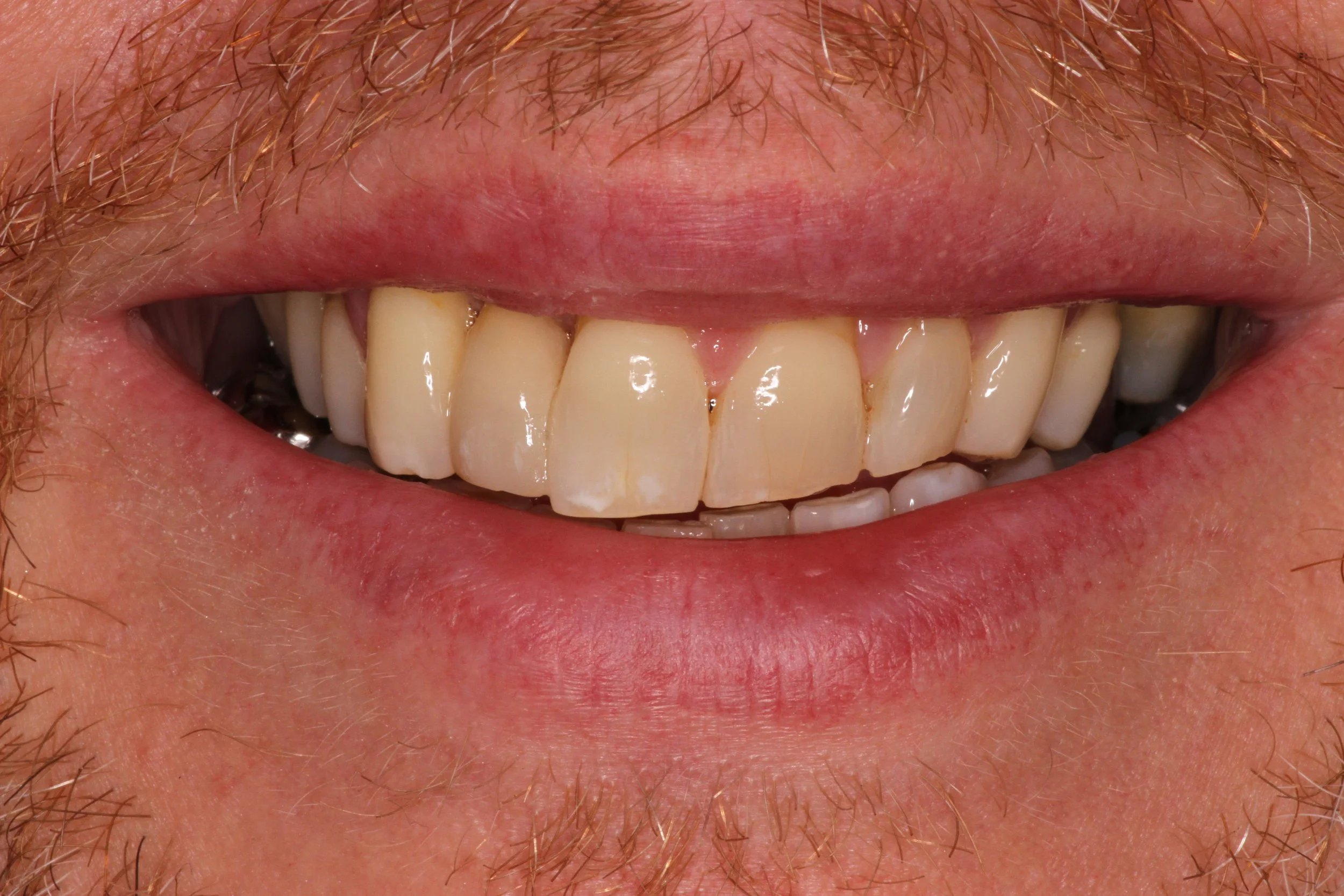 Close-up of a person's smile showing teeth with some plaque and staining, and lips and facial hair.