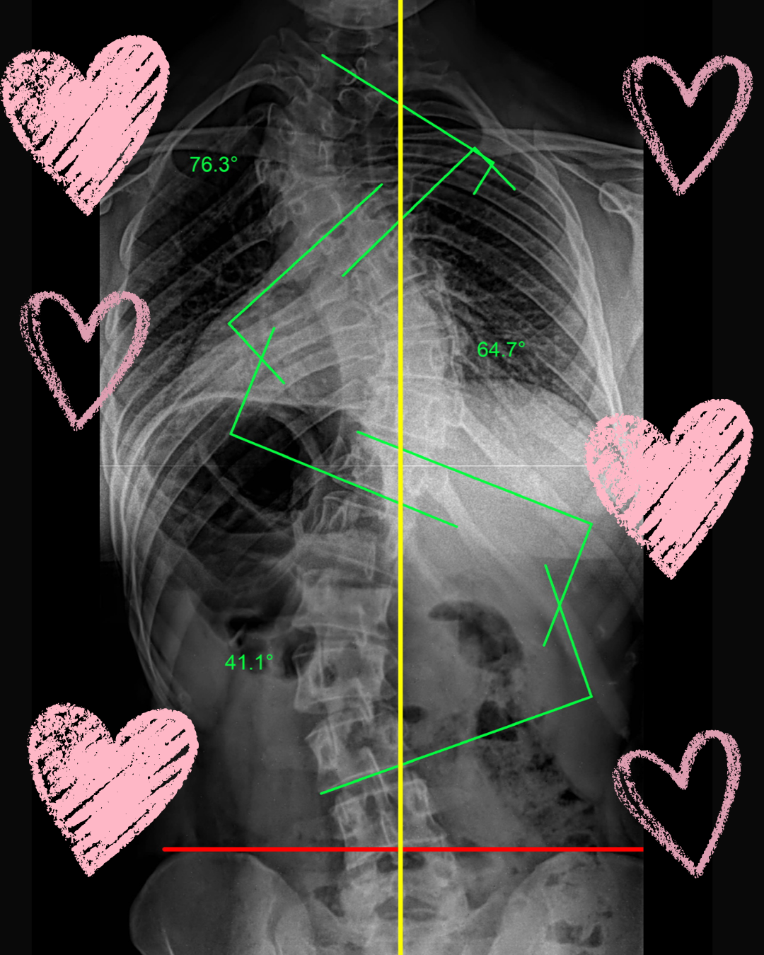 Scoliosis and Self Love: My Honest Valentine’s Day Reflection