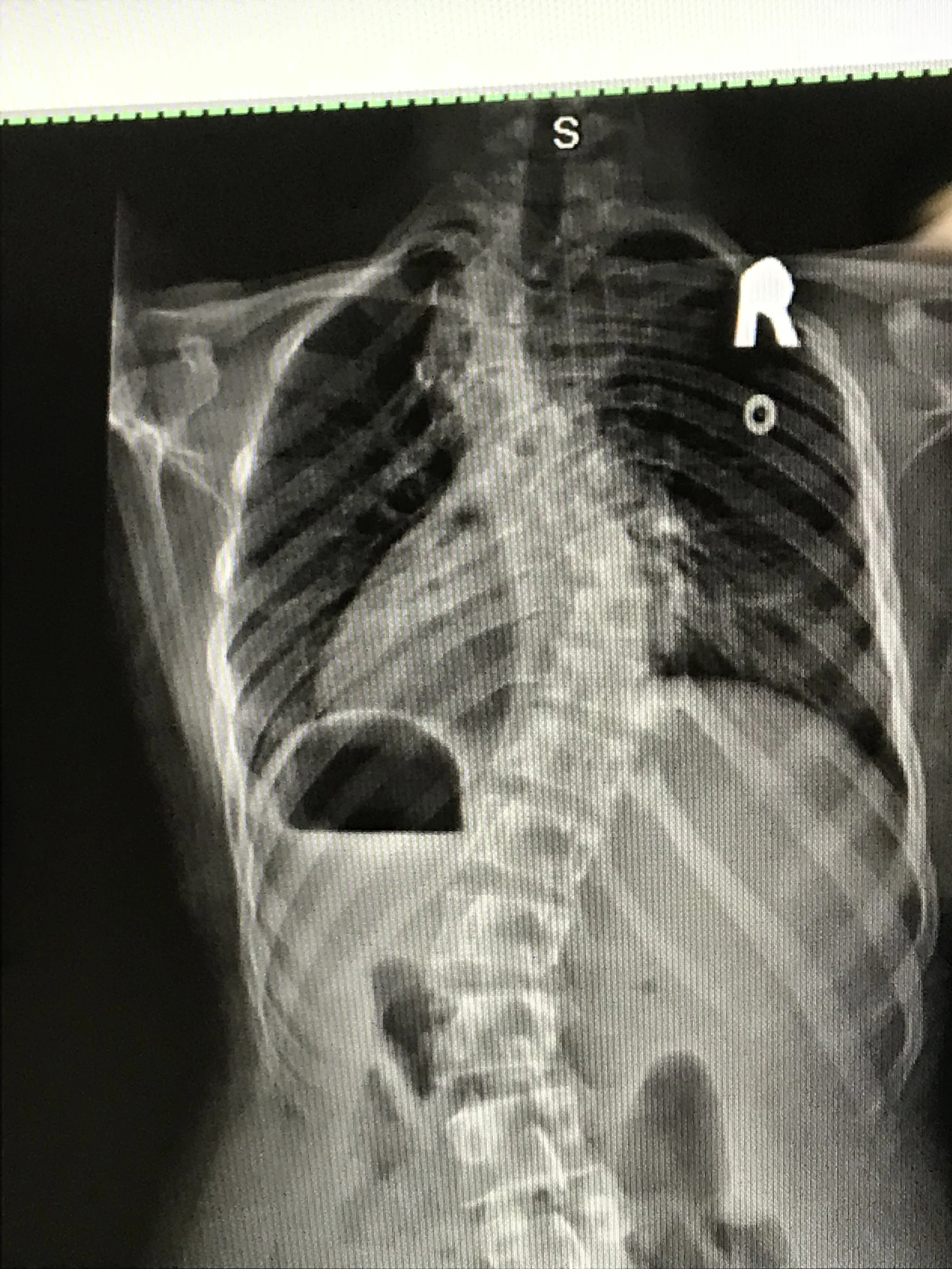 Mental Health Awareness and Scoliosis: The Psychological impact of Scoliosis