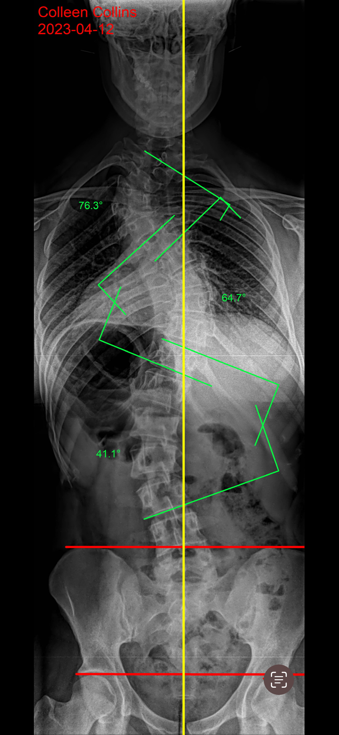 Xray Radiograph of a Scoliosis spine