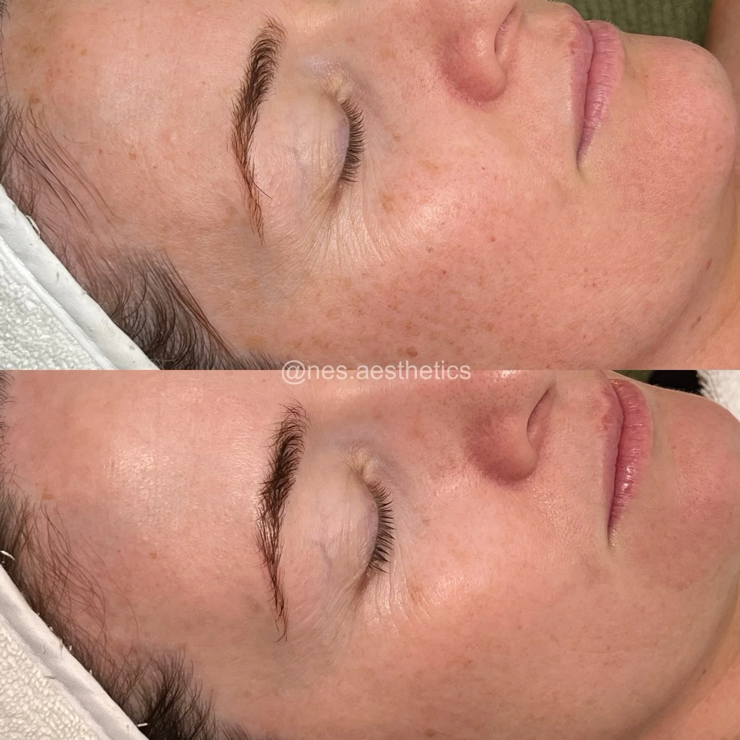 Clarity. Tone. Improved Light reflection.

This visible improvement is after just one of our ALMA IPL Vascular + Pigment Rejuvenation Face Treatments via our ALMA Harmony device. 

You can see:
&bull; Brighter overall skin clarity, and quality 
&bull
