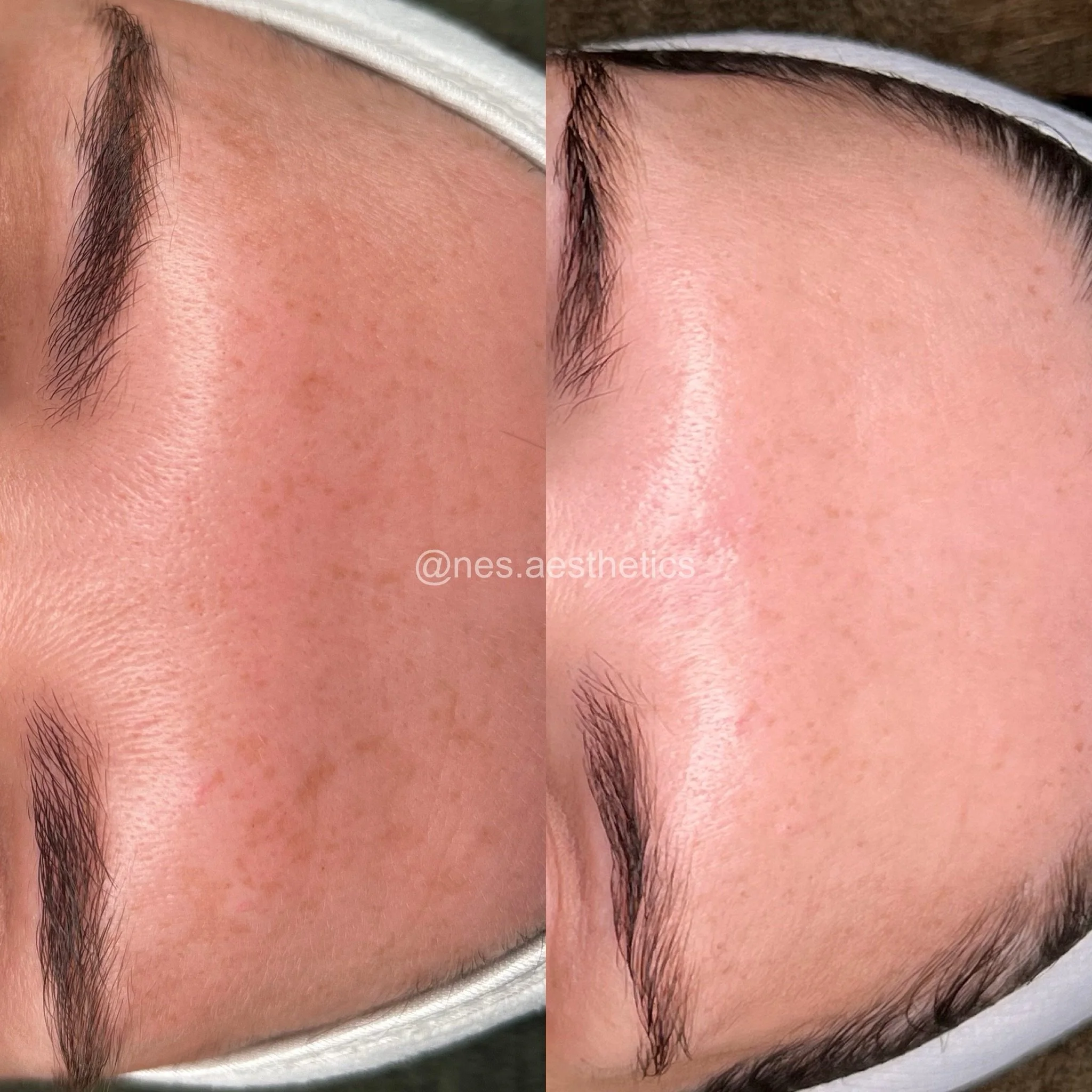 Melasma and pigmentation need strategy ~ not quick fixes.

These results followed 4 sessions of our signature 
Microneedling | Collagen + Cellular Repair treatment over 5 months, with visible improvement in:

&bull; Melasma and pigmentation
&bull; Sk