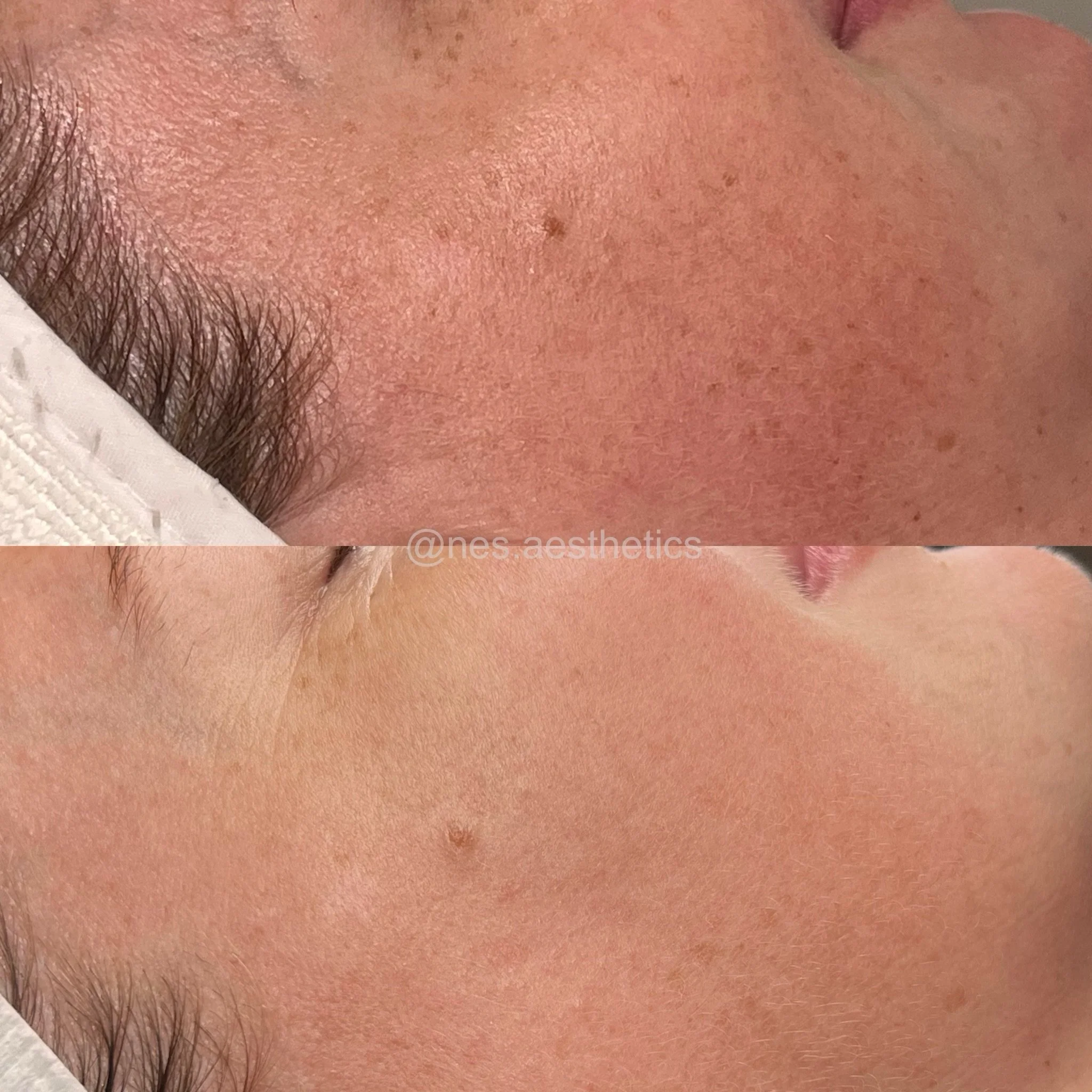 The skin tells the story ~

These before &amp; afters followed just 2 of our ALMA IPL Photofacial sessions ~ but the outcome is about more than the treatment itself.

At NES, we prioritise skin preparation, barrier health, and the right home prescrip