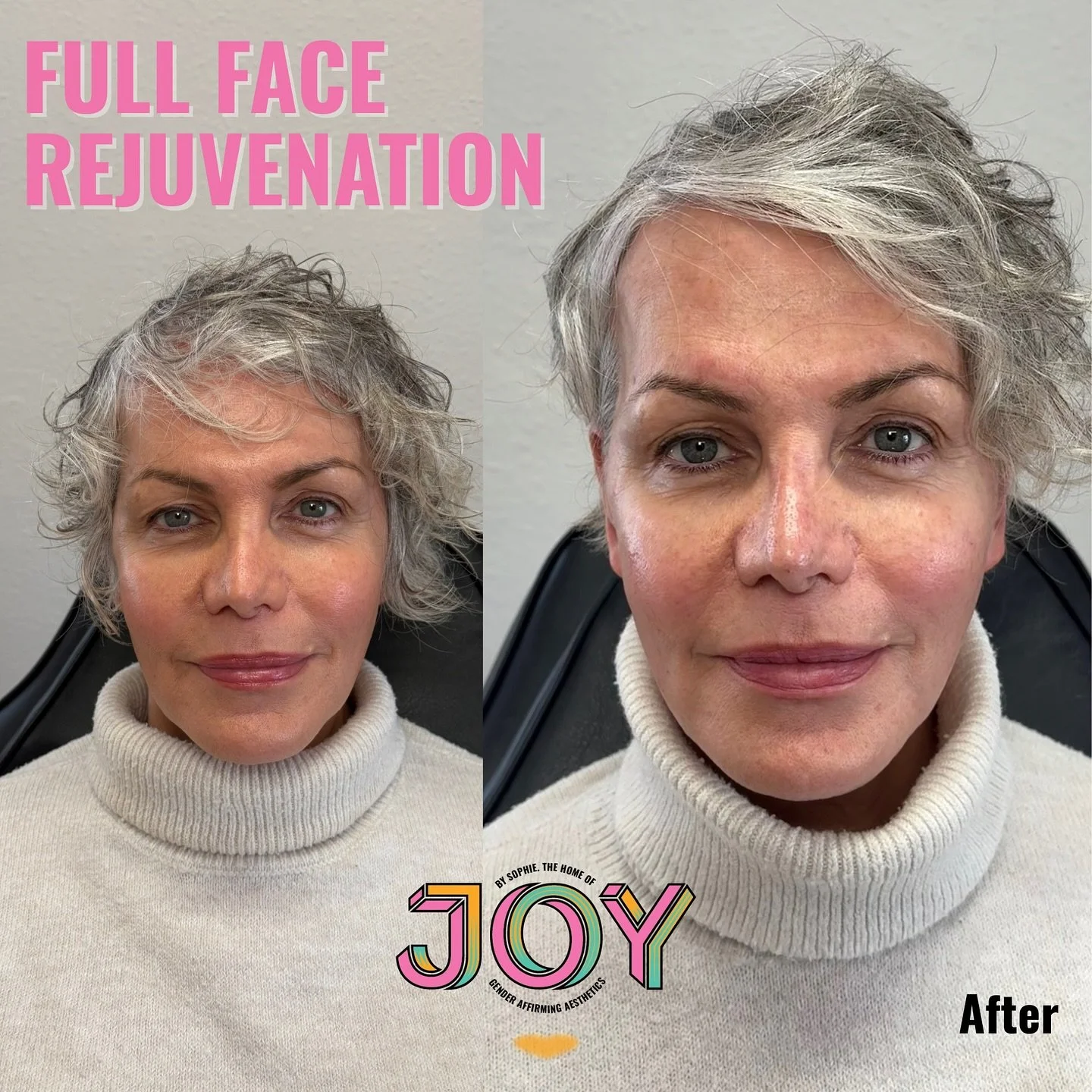 Full face rejuvenation for the queen herself focusing on mid face, jawline and the nose. I used 4MLS of dermal filler strategically to lift, harmonise and refresh. Proving that injectables don't need to look overdone or unnatural to still have impact