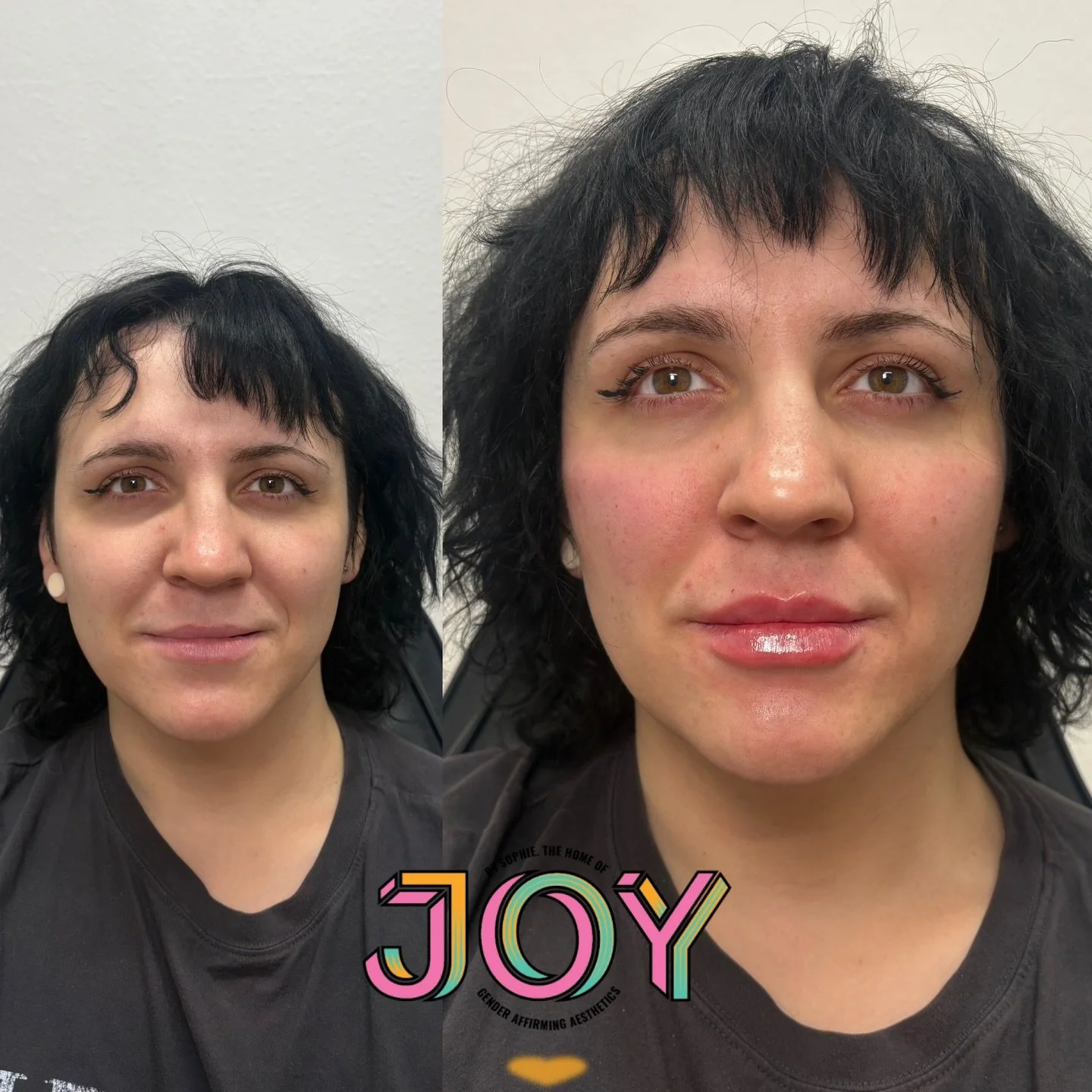 One of my favourite parts of my iob is getting to see familiar faces returning and catching up on all their stories (and this catch up had lots of exciting stories 🥹🫶🏼) 

My lovely patient wanted to add some femininity, we used 3ml of dermal fille