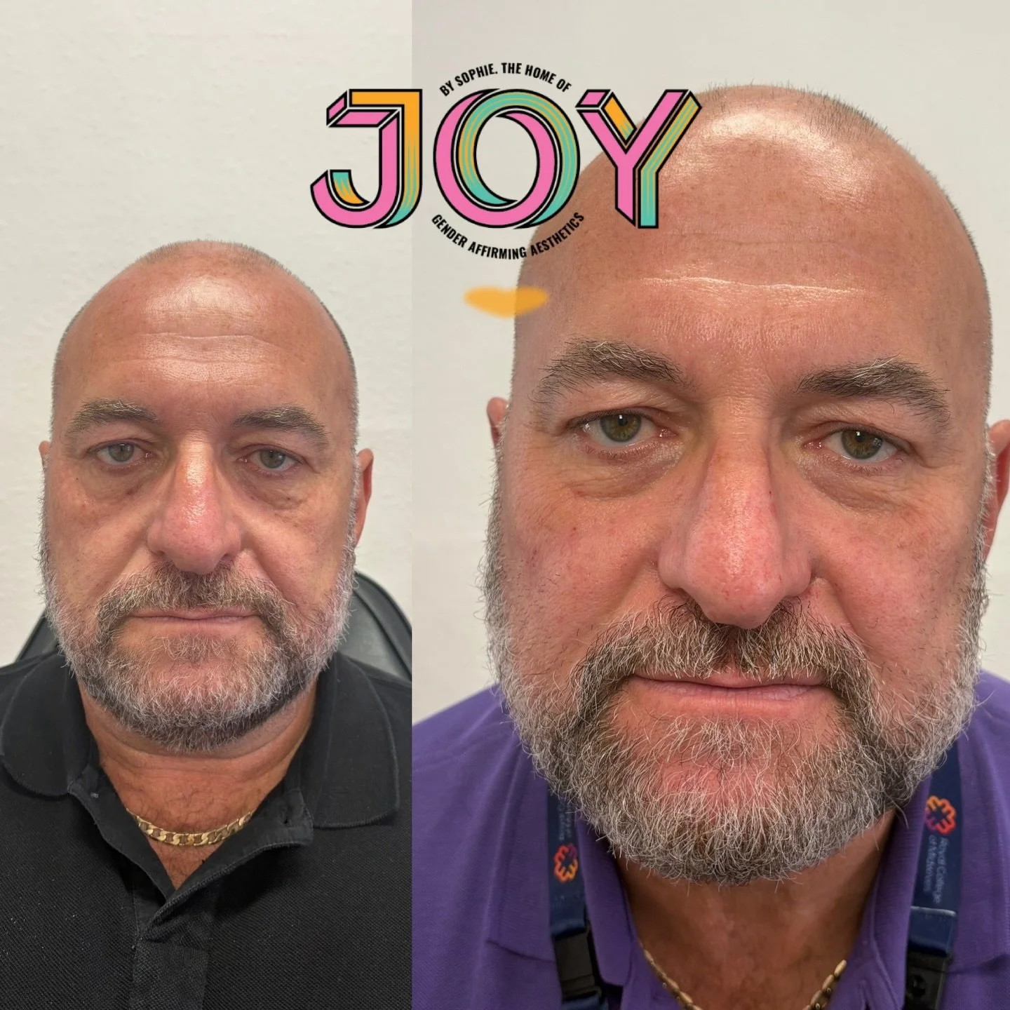 A little refresh for this handsome chap 💉 Using 4ml overall across the cheeks in the deep and superficial fat pads, keeping it undetectable but still impactful 👩🏼&zwj;⚕️ 

Combined with an undereye mesotherapy treatment by @thebeautygurusalon ✨ 

