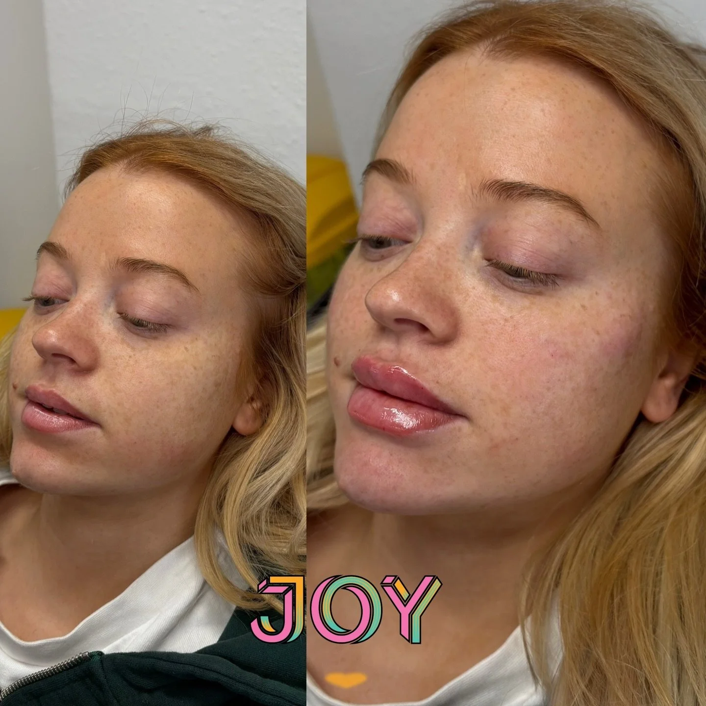 A little festive refresh for my lovely patient. We have slowly built up her lips after dissolving them to achieve the fuller pout. Also added some subtle facial balancing to reduce shadowing and give definition 💉✨

Love having this gorgeous girl in 