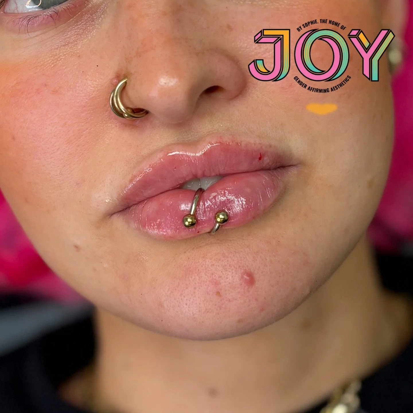 Fresh off the needle! A little Christmas top up for this queen focusing on definition and a little bit of rehydration. Using my fav Stylage Special Lips and finished off with Aftermed 👩🏼&zwj;⚕️✨💉

I have some appointments left this month if anyone