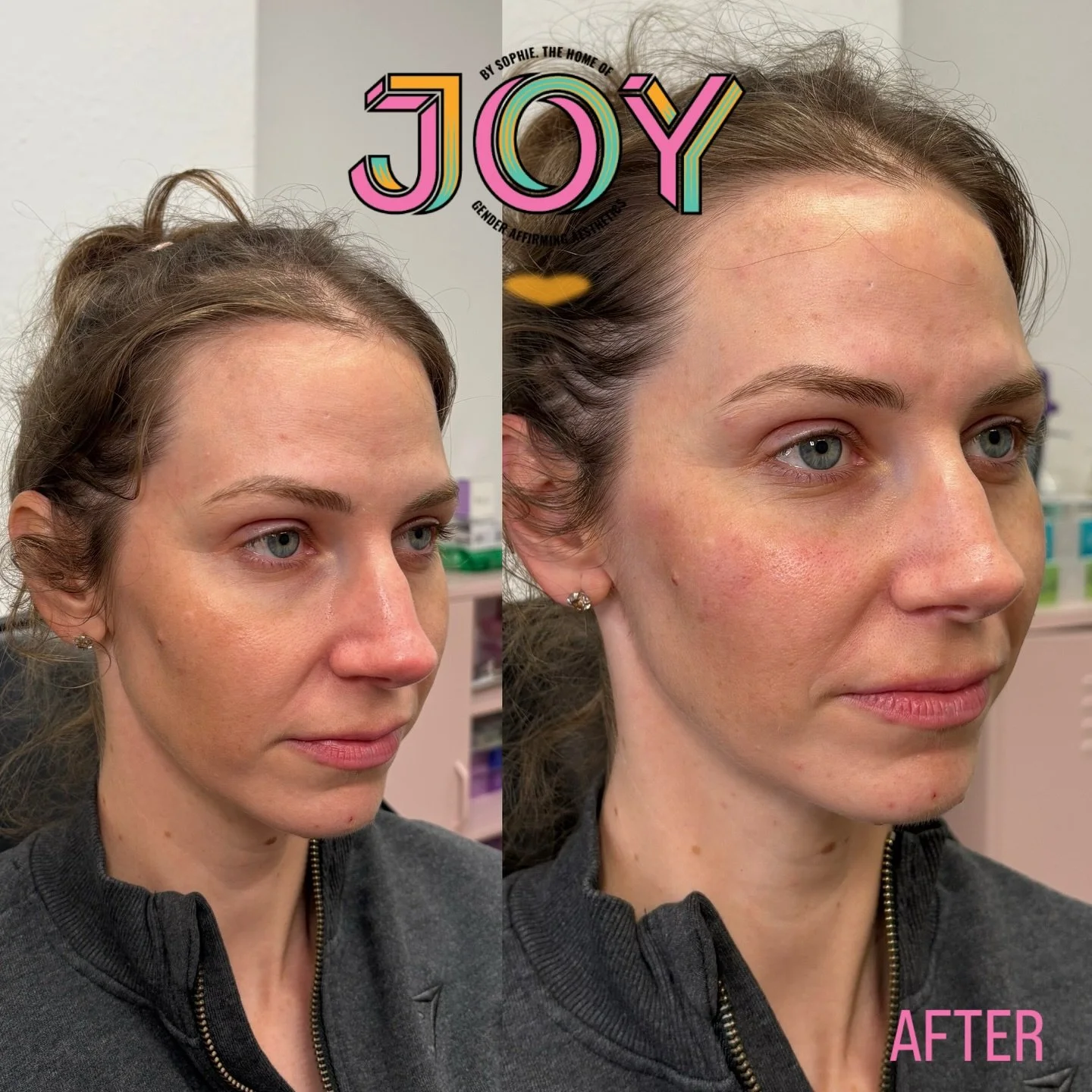 Just a little tweak 💉💉 

I strategically placed 2ml of dermal filler across the face to achieve this little refresh. Where do you think I injected? Answers on a postcard (or in the comments below hehe) 

I have limited appointments before closing f