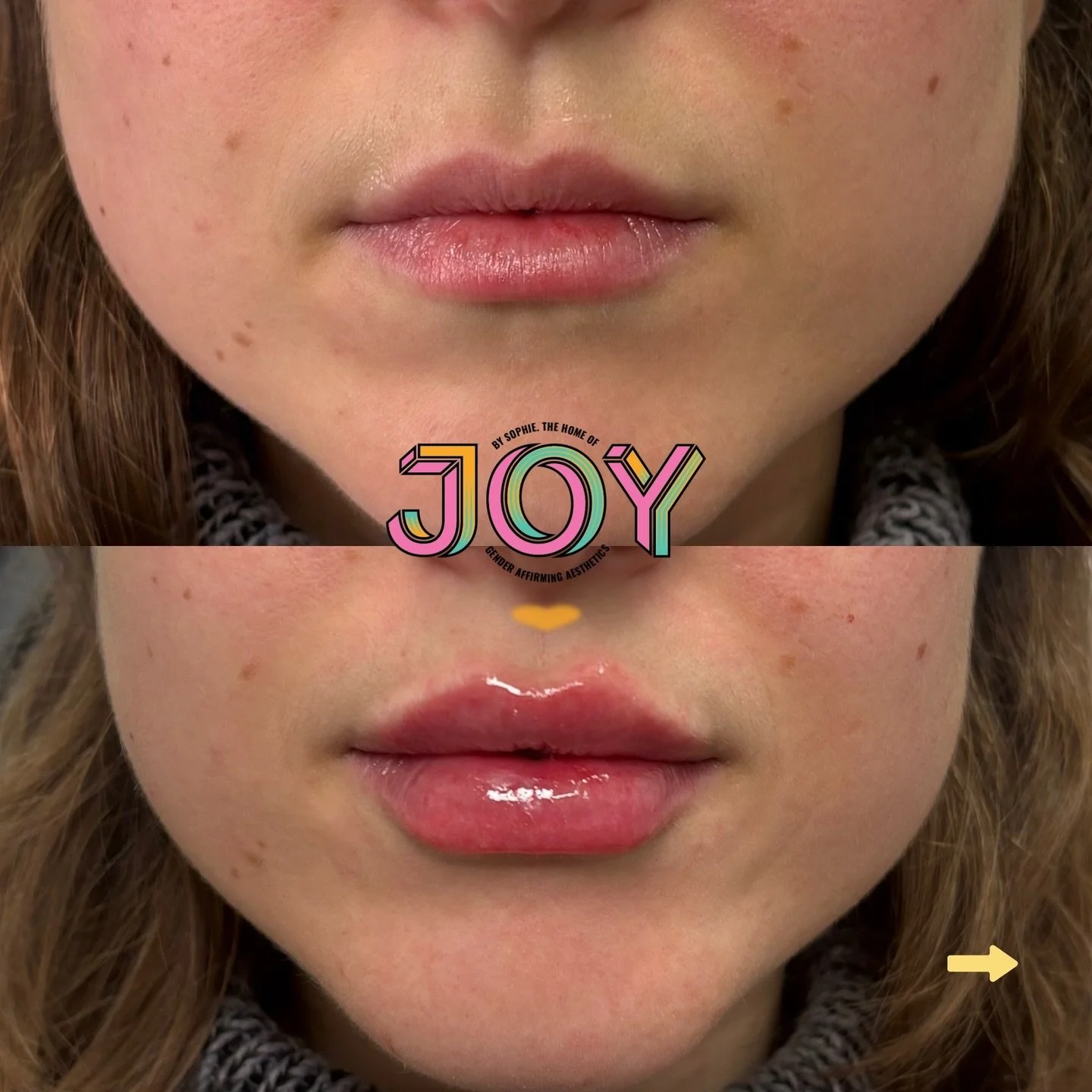 One thing I always look for with lip filler? How it looks when you smile.
Lips are one of the most expressive parts of the face, so using a dynamic, high-quality filler is key. Stylage Lips Plus integrates into the tissue, allowing natural movement a