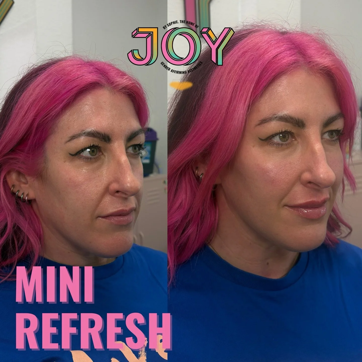 A little mini refresh for this absolute queen. I replaced some lost volume in the midface restoring that OGEE curve, before focusing on revolumising the upper lip and balancing out the bottom.

👩🏼&zwj;⚕️ Nurse Led Aesthetic clinic
📍 Chorlton, Sout