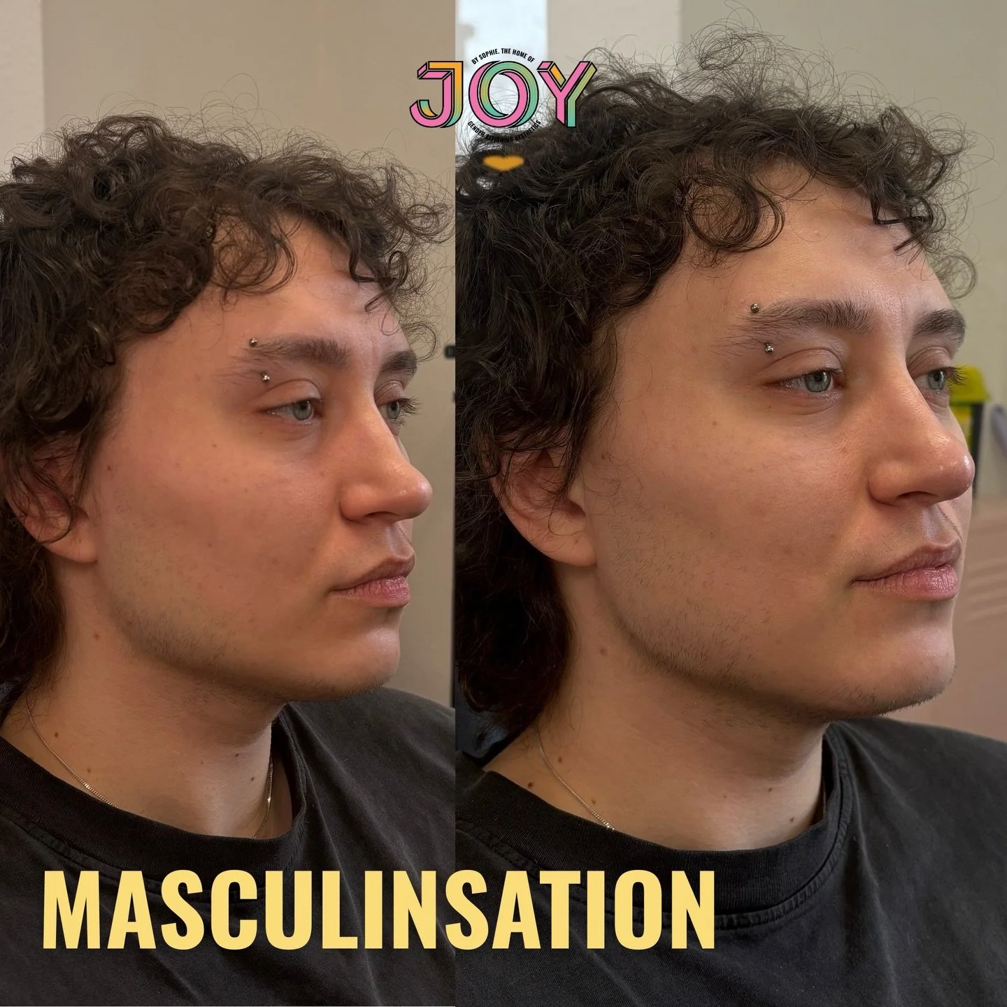 Still swooning over this jawline. Using my favourite XXL to widen and strengthen the lower face, focusing on the gonial arch and the chin before defining along the jawline 💉👩&zwj;⚕️

💉 4.5ml of Stylage XXL in the jawline for maximum projection and