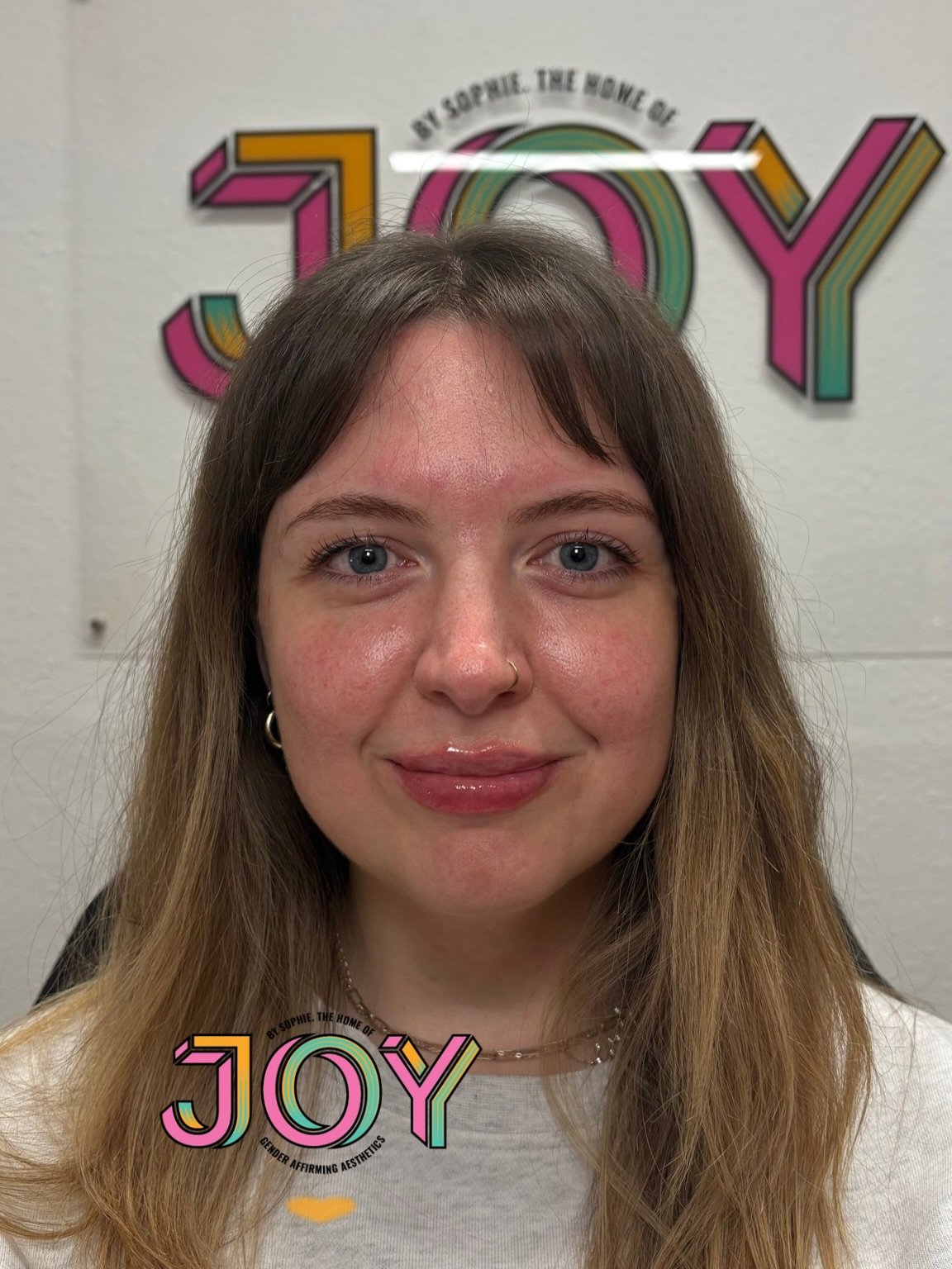 Just look at that smile ✨ These were the last set of lips I did before I left for Australia and I remember feeling so buzzed that the last set I did were just 🤌🏼🤌🏼🤌🏼 

Lil bit of swelling can be seen this will go down in a couple of days. I use