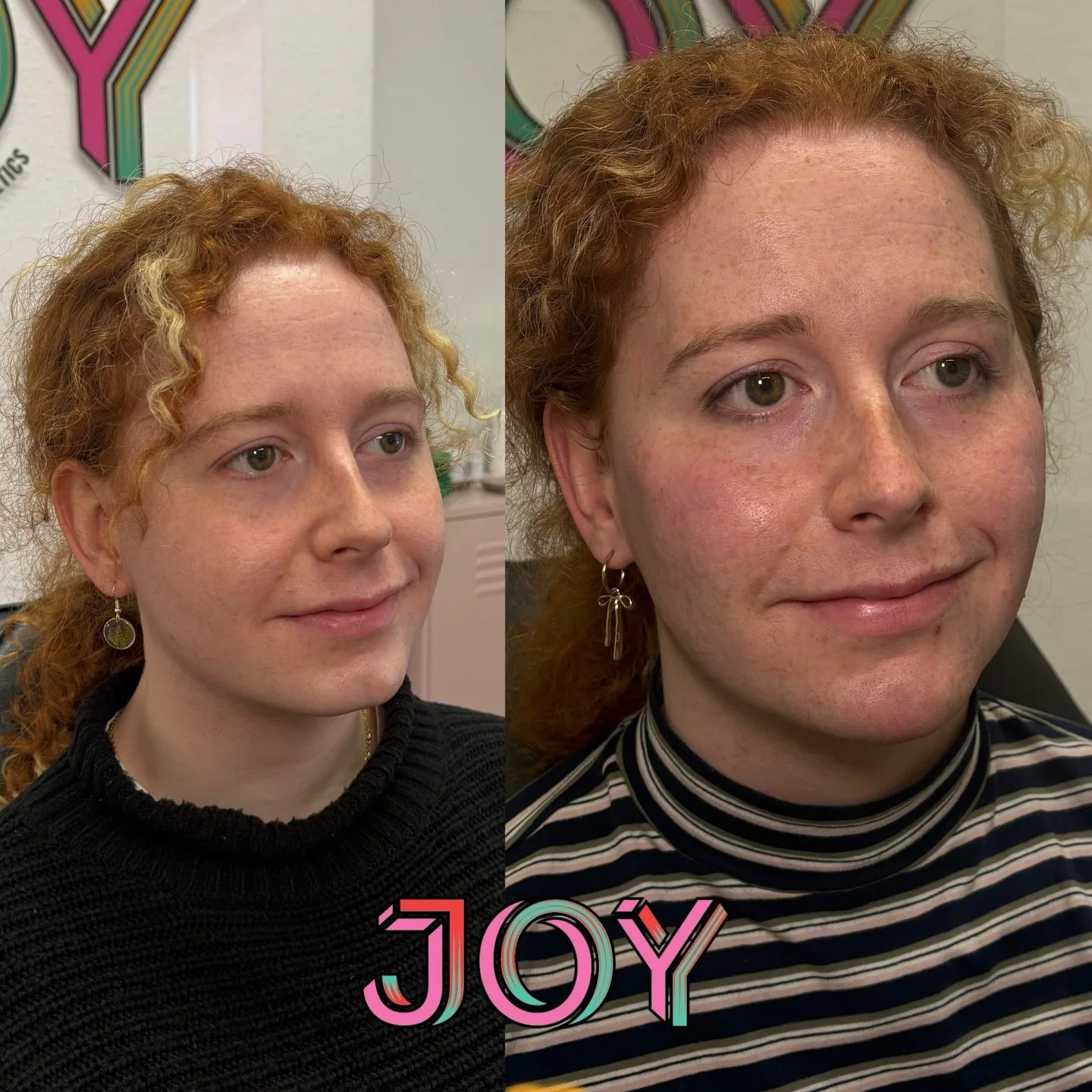 One of my favs from recent weeks. We focused on the mid face and chin to add some soft contour and femininity for my lovely patient ✨

We used 4ml in total to achieve this result.  Stylage XXL and Stylage L, for natural and long lasting results👩🏻&z