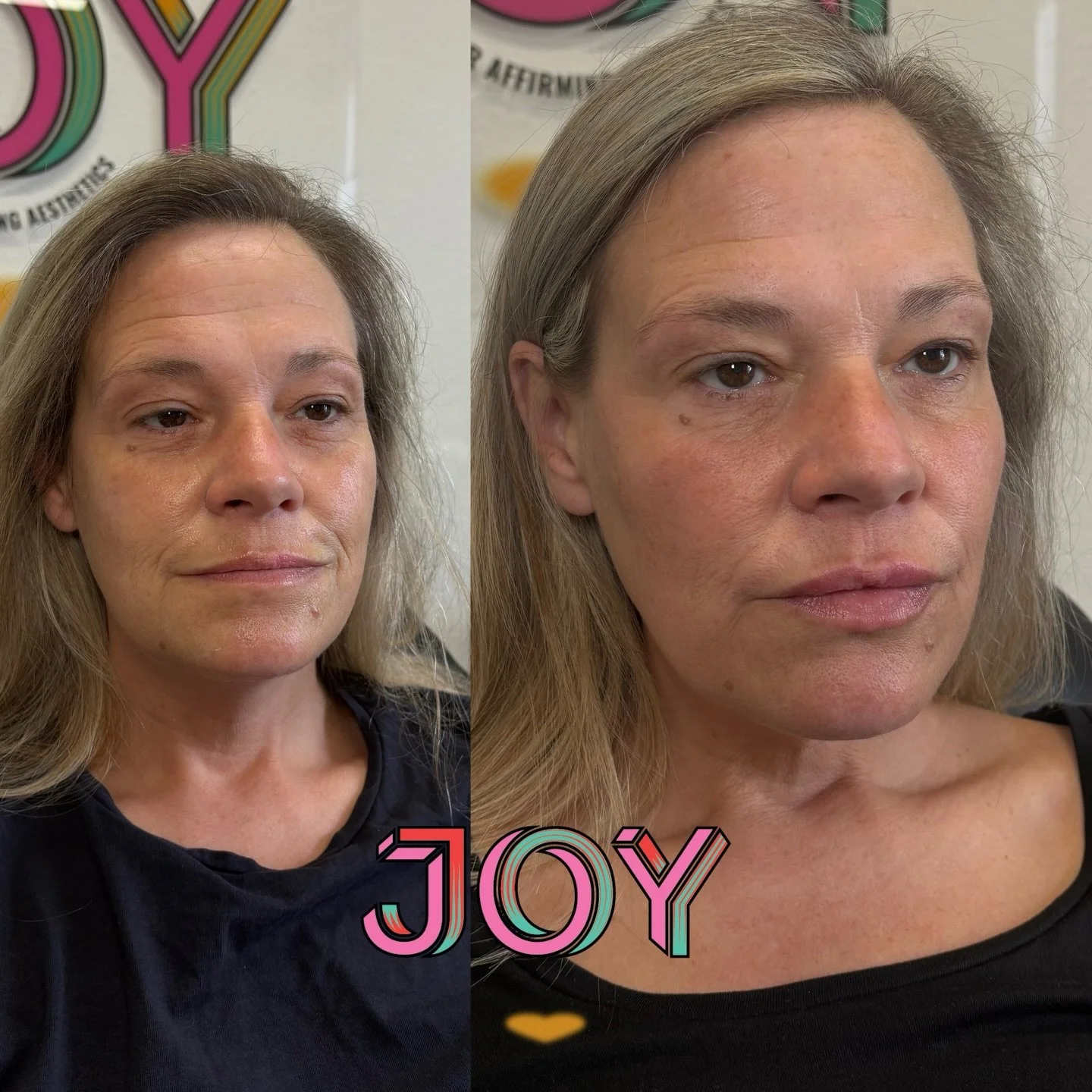 The best injectables are undetectable but that doesn't mean they shouldn't be impactful. Absolutely loved doing this treatment for my beautiful patient ✨

If you have ever felt intimidated by aesthetic clinics, or want to try injectables but don't kn