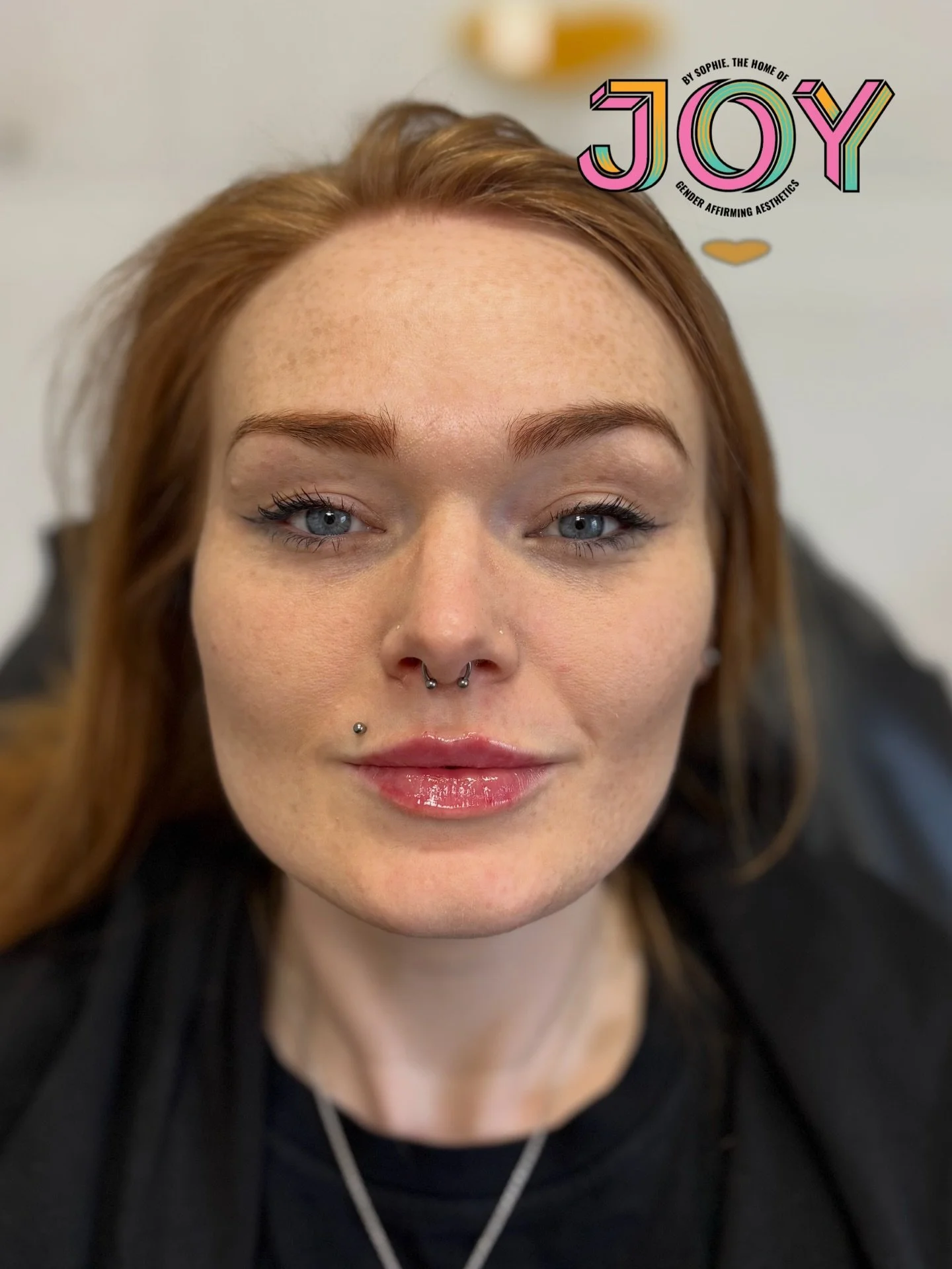 Adding some definition and soft volume for my patients yearly top up. Good injectables don't shout, they whisper 🫶🏼👩🏻&zwj;⚕️💉

Send me a DM to book yours now 💌

Love, Sophs 🌈 xx

#personalisedresults #lipfillerbeforeandafter #joybysophie #subt
