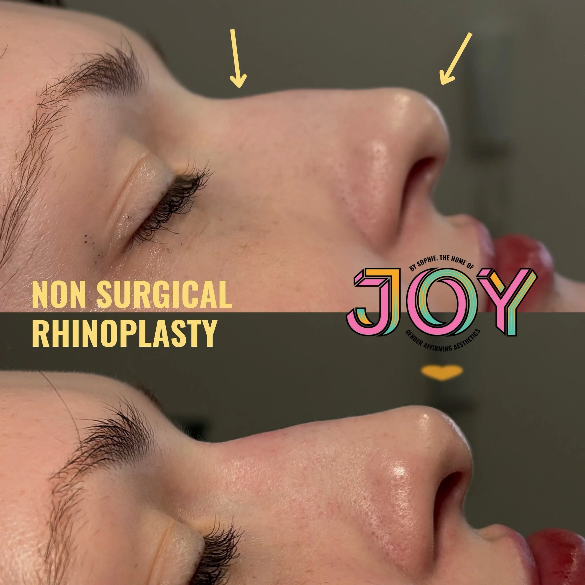 Amazing non surgical rhinoplasty result for my gorgeous patient 🩷 Focusing on smoothing the bump and lifting the tip of the nose.  This really is a life changing treatment for those seeking impactful changes but don't want to go down the surgical ro