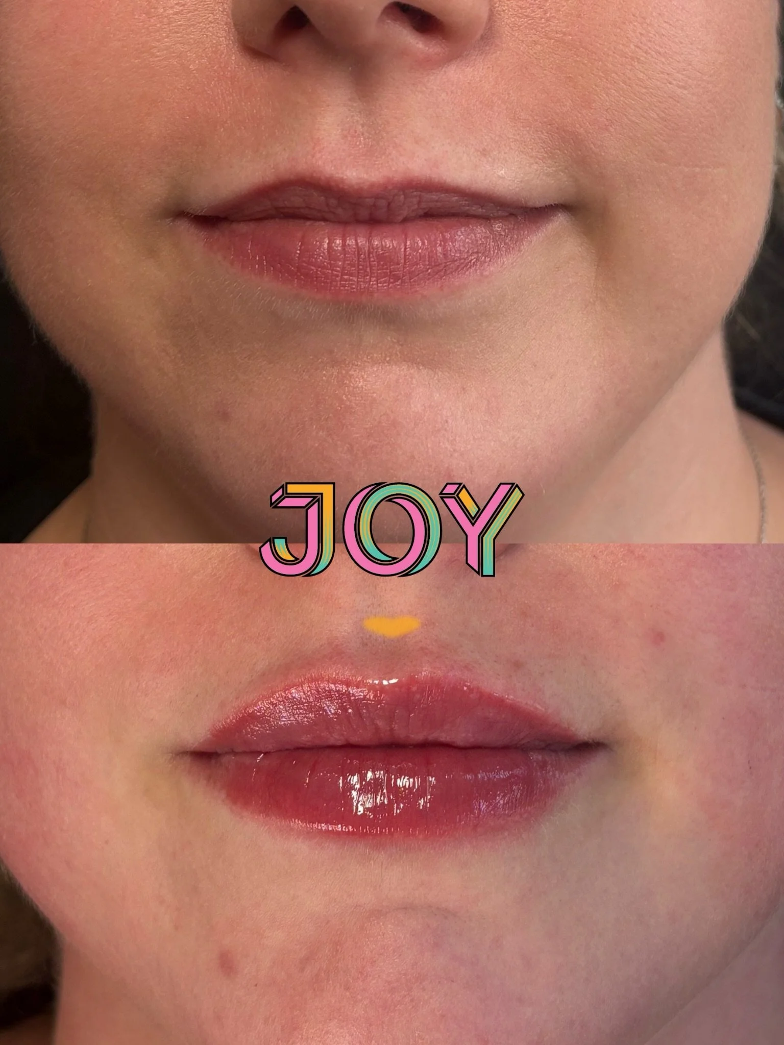 When the lip filler plans finally make it out the GC! I injected my friends lips just before the weekend and when I tell you I have looked at the before and after picture everyday since, I aint lyin!!!! 😮&zwj;💨😮&zwj;💨😮&zwj;💨😮&zwj;💨(Swipe to s