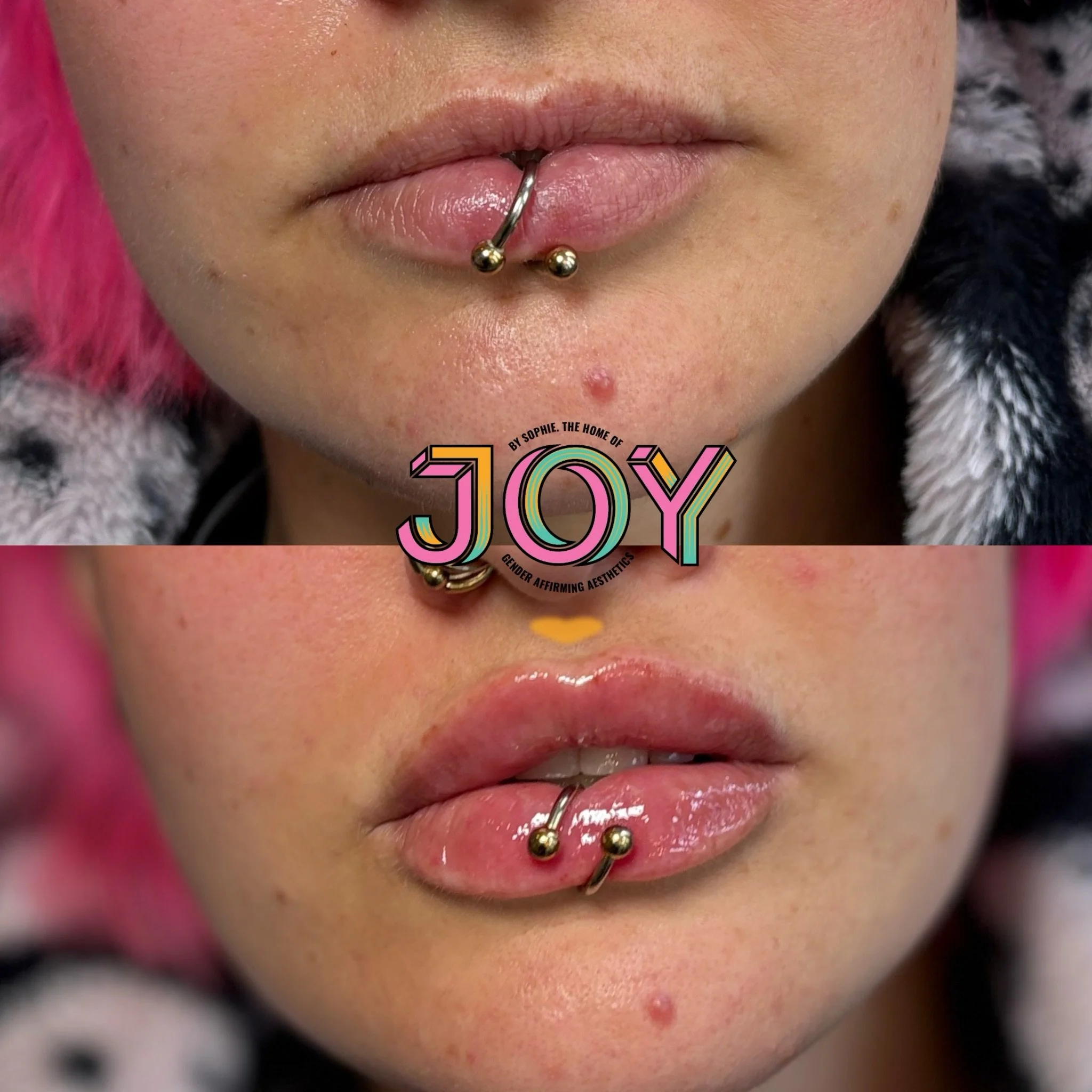 For the gorls who like them a lil juicier 🍓 A little pre-download top up for the gorgeous Lizzie using Stylage M for a more voluminous pout 💉

I have vvvvv minimal spaces left in June and July is filling up, this is your sign to book in early 🫶🏼?
