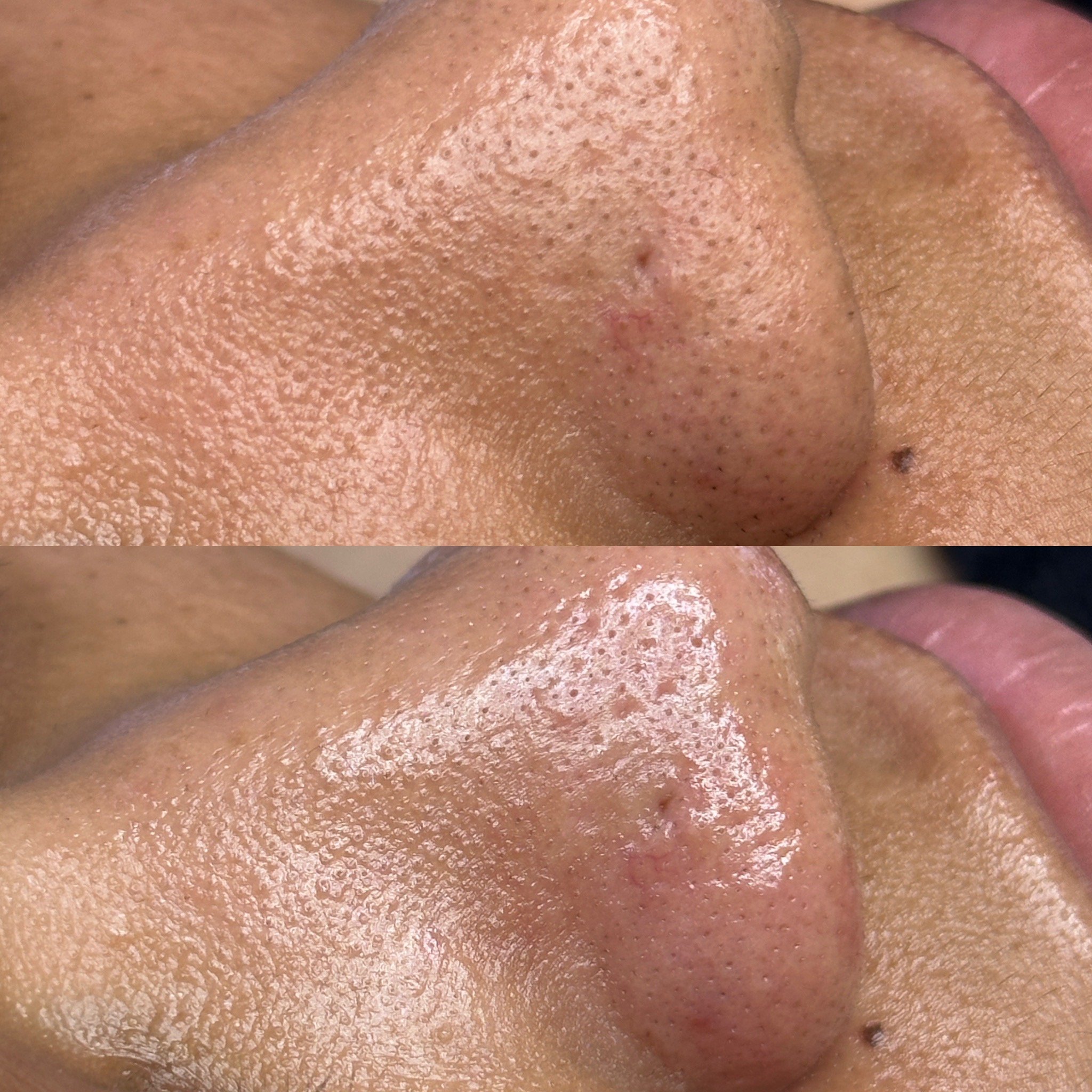 Close-up of a person's nose, before and after skincare treatment, showing reduced blackheads and smoother skin texture.
