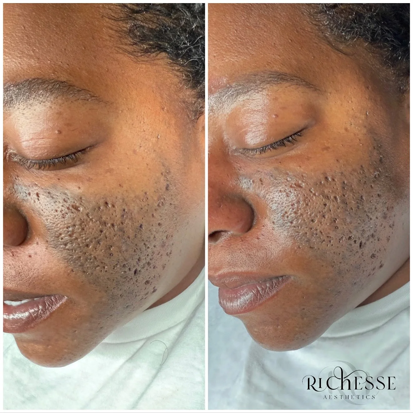 Skin like this doesn&rsquo;t happen overnight and it&rsquo;s not from &ldquo;not taking care of it.&rdquo;

It&rsquo;s often a combination of hormones, inflammation, genetics, harsh products, and sometimes even health conditions or prescribed medicat