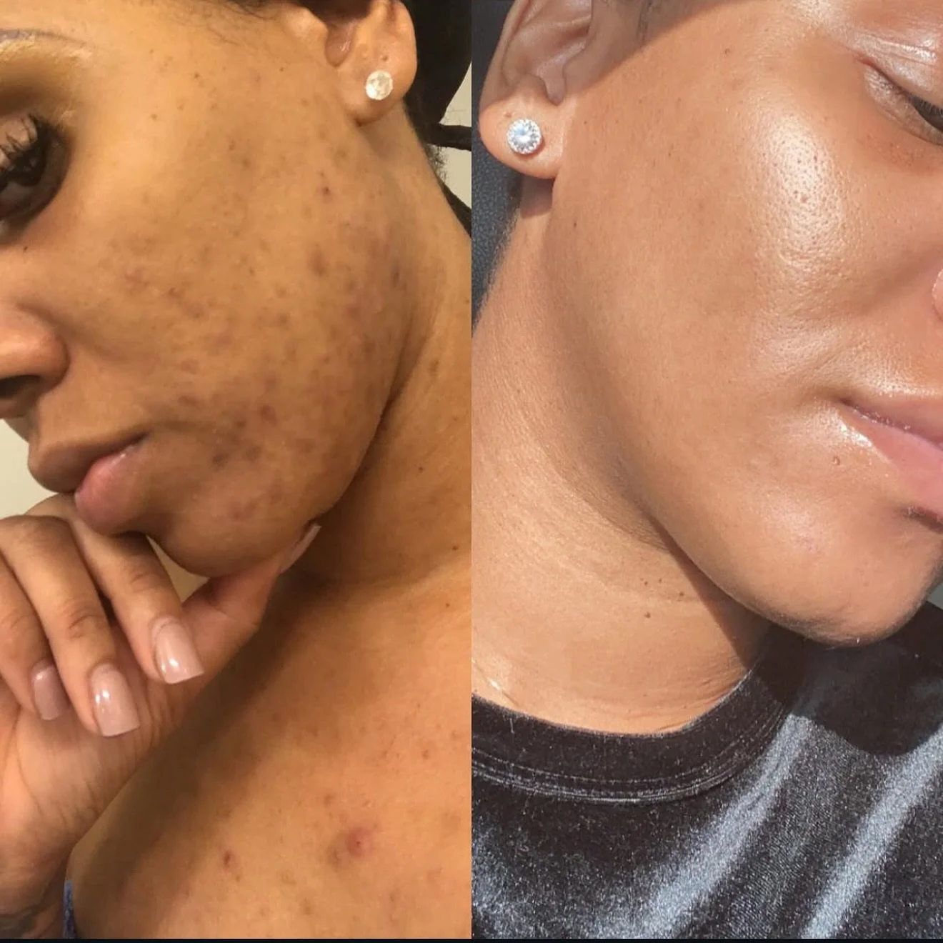 I used to struggle with acne and hyperpigmentation; the kind that hurts your confidence every time you look in the mirror.

I went to a dermatologist and was prescribed Accutane. It was so harsh on my body, and after six months, my acne came back. Th