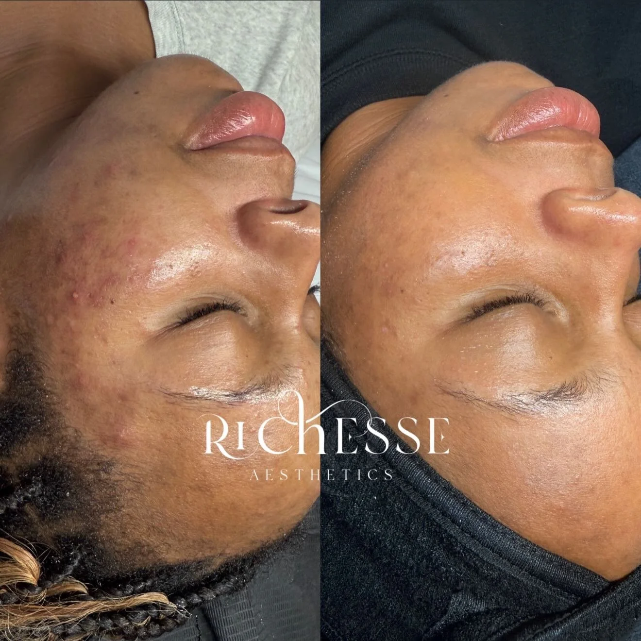 Consistency is key.

This is why corrective skincare matters. With the right treatments and home care, your skin can improve.

If you&rsquo;re dealing with acne, hyperpigmentation, or texture, let&rsquo;s work on a treatment plan for your skin.

Book
