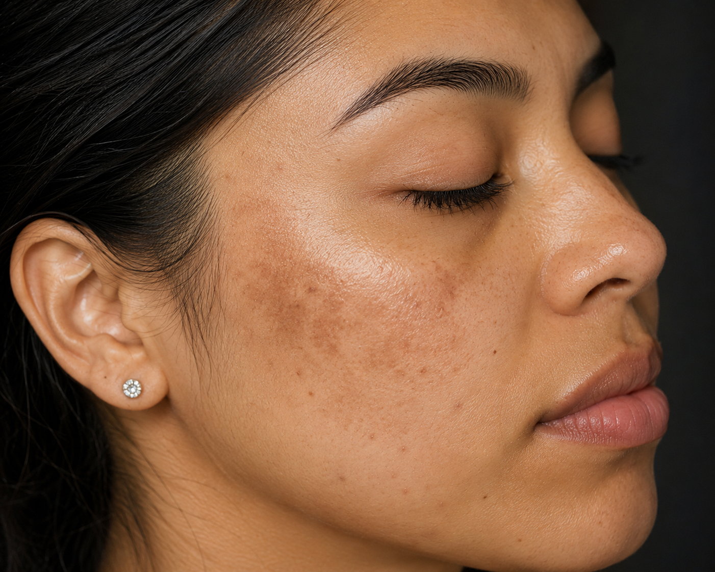Melanin-rich skin with acne marks, dark spots, and uneven skin tone