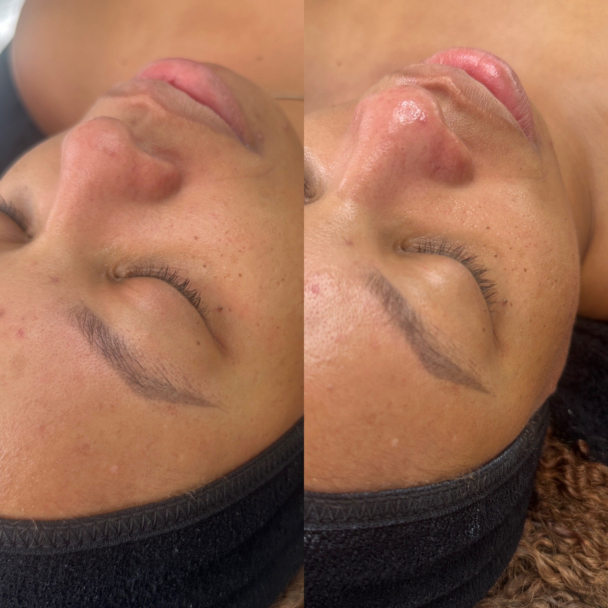 Before and after facial treatment on a woman's face showing smoother skin and reduced blemishes.