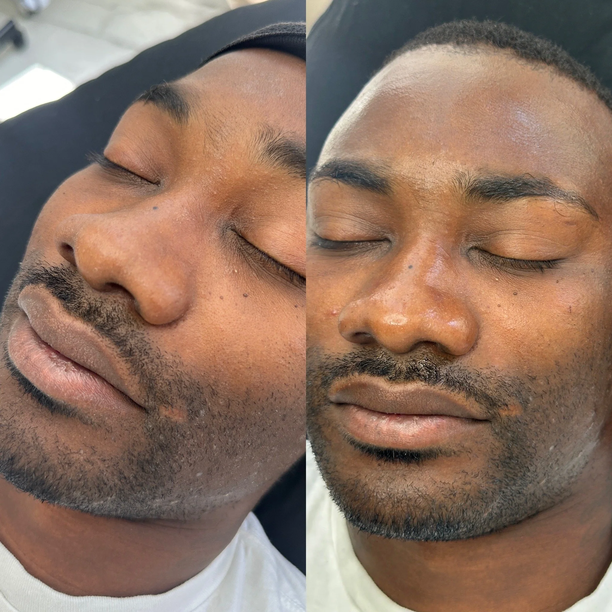 Before and after facial treatment comparison on a man's face, showing improved skin texture and appearance.
