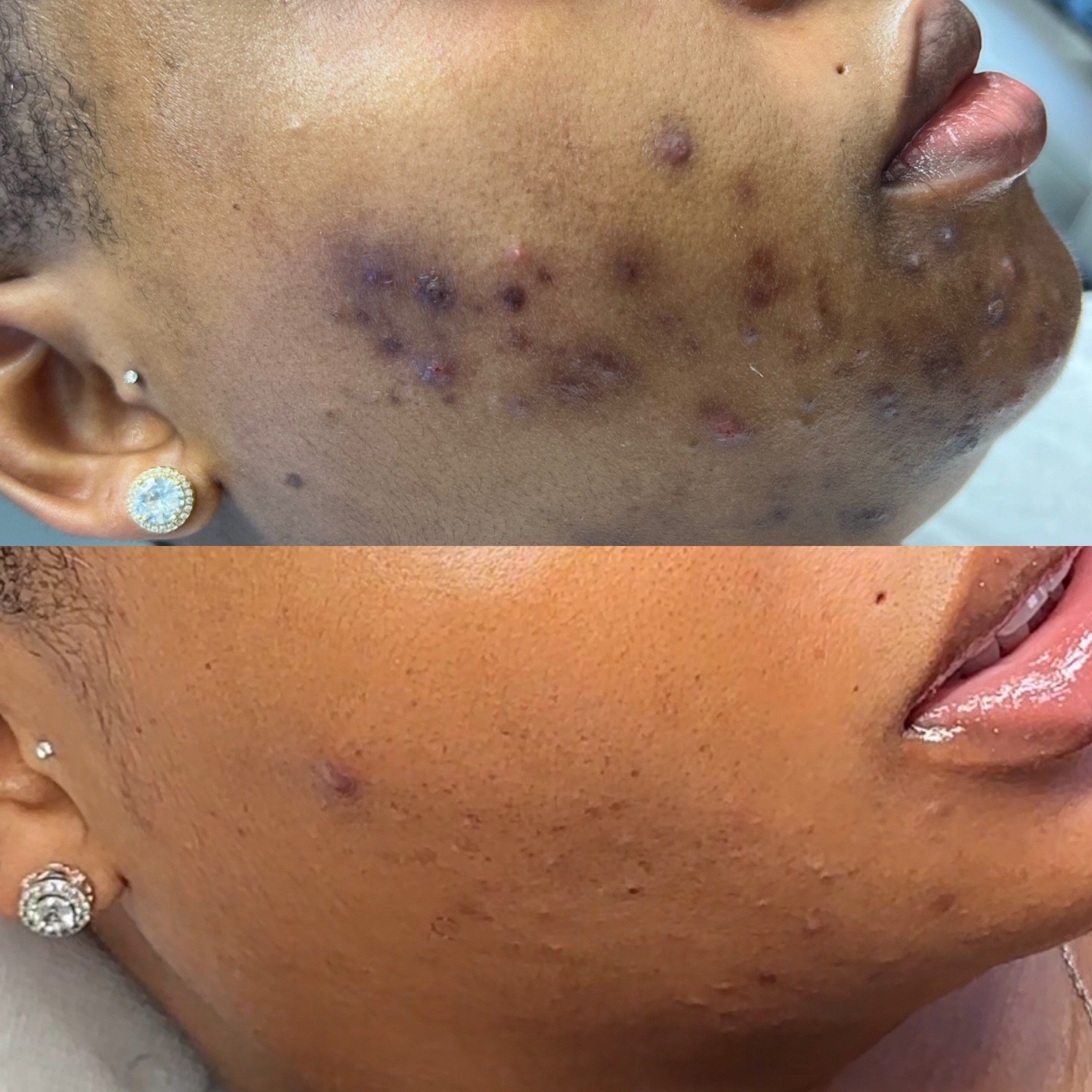 Before and after images of a person's cheek showing improvement in acne, reduced blemishes, and clearer skin.
