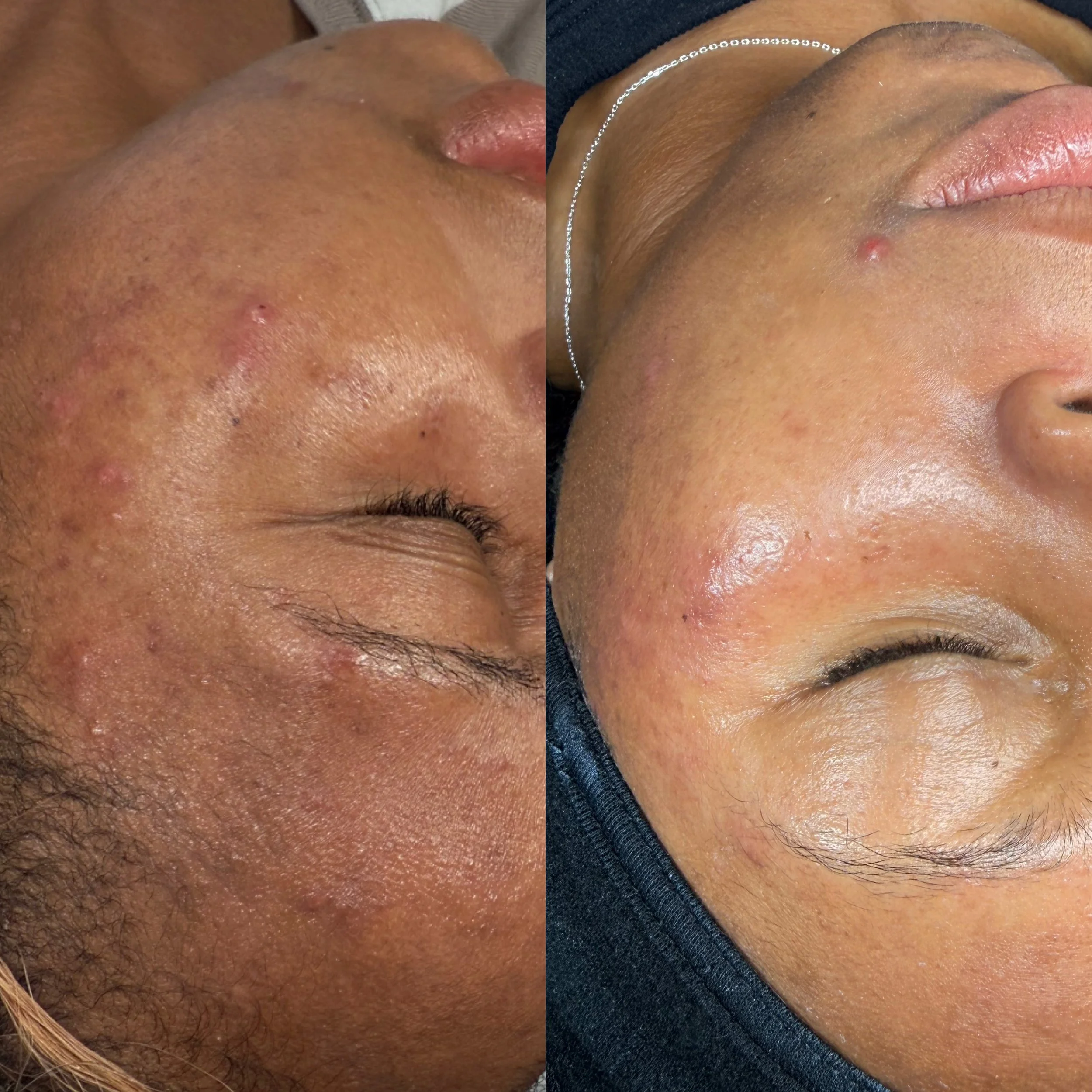 Before and after corrective skincare treatment for acne, hyperpigmentation, and uneven texture.