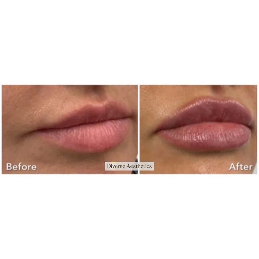 Absolutely thrilled to share this transformation! 

💋 My lovely client came in with a vision for plump, juicy lips, and we made it happen! The result? Beautifully enhanced lips that radiate confidence and allure. If you&rsquo;re looking to achieve y
