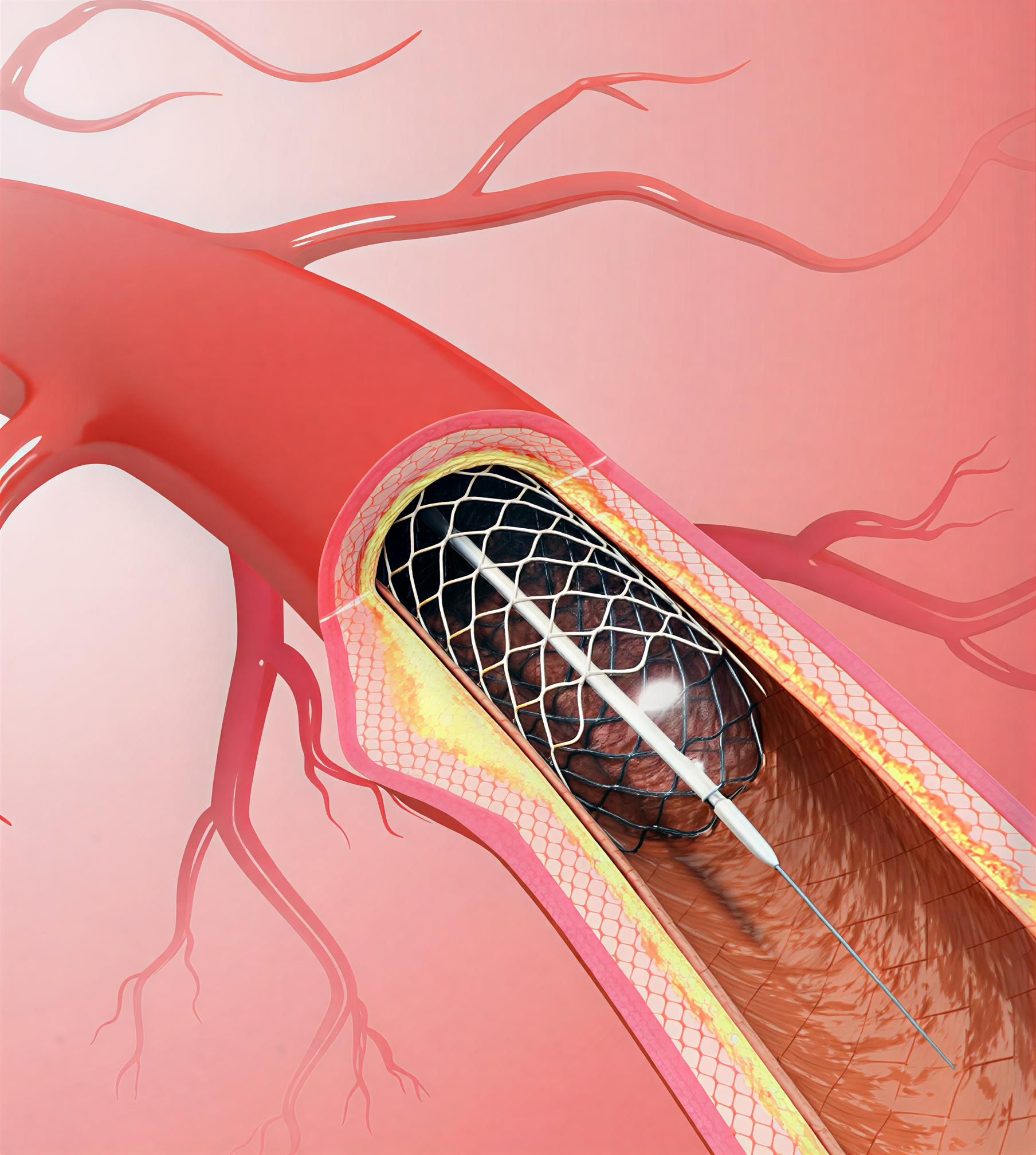 Heart Stent